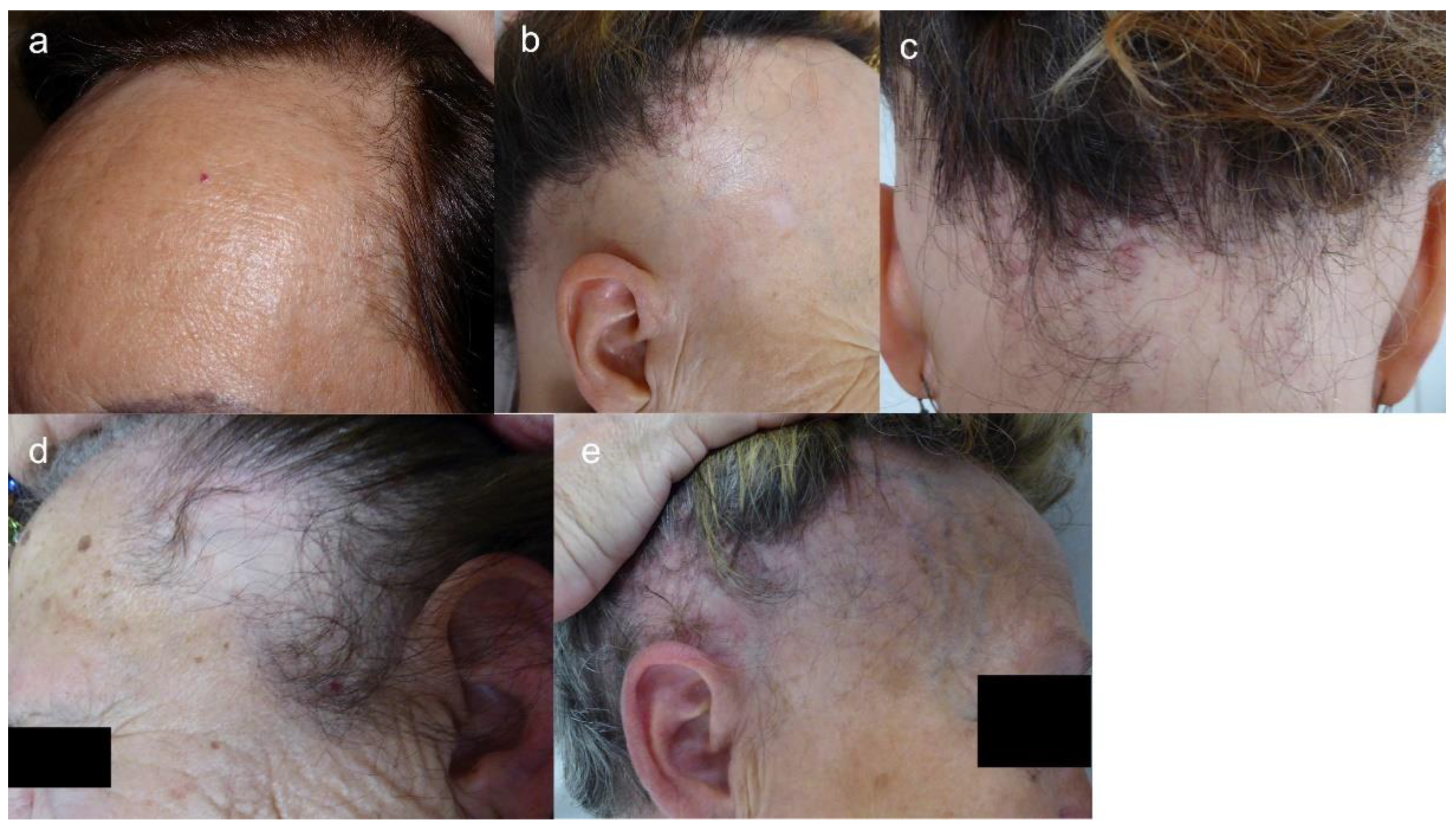 JCM | Free Full-Text | Frontal Fibrosing Alopecia: A Review