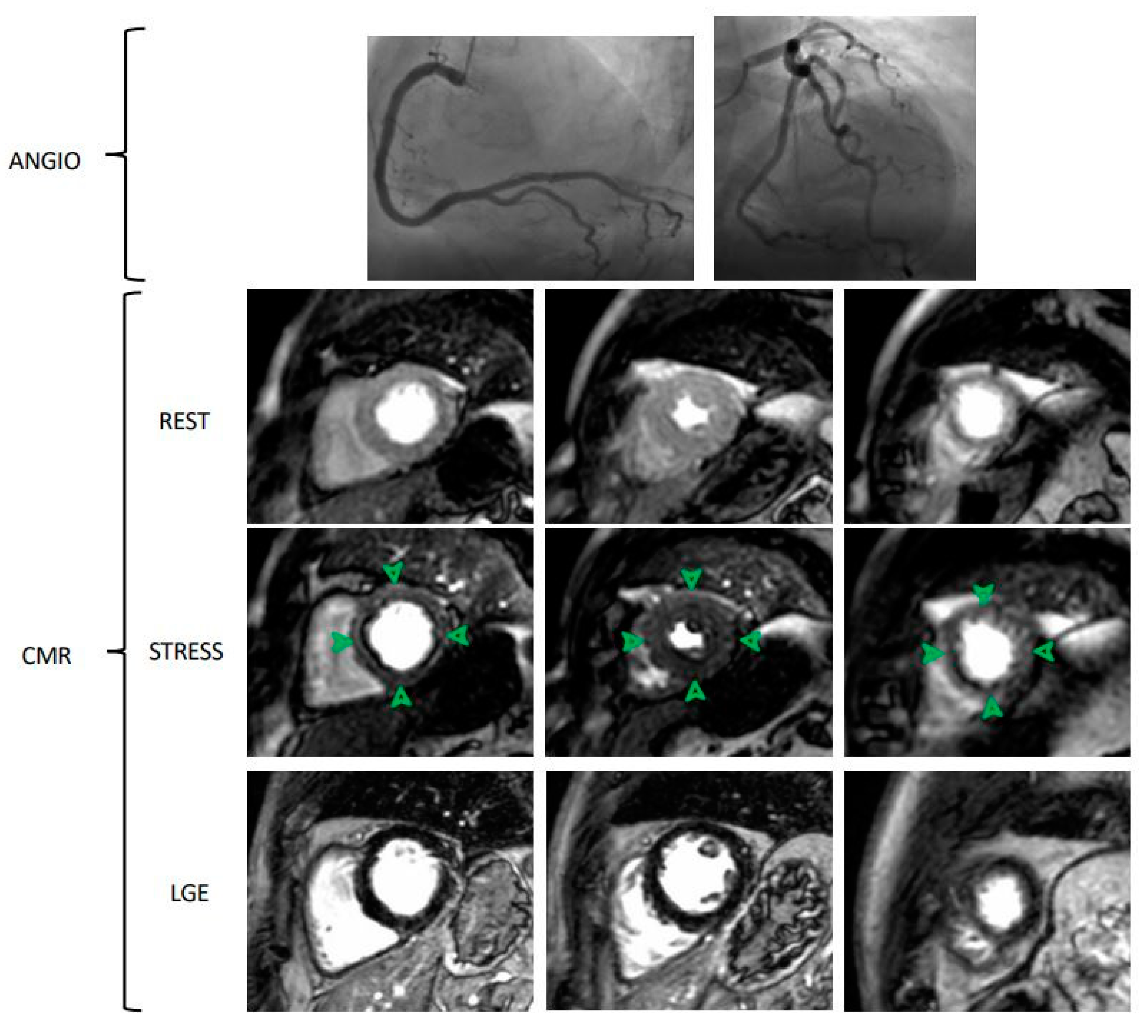 JCM Free FullText Coronary Microvascular Dysfunction PET, CMR and