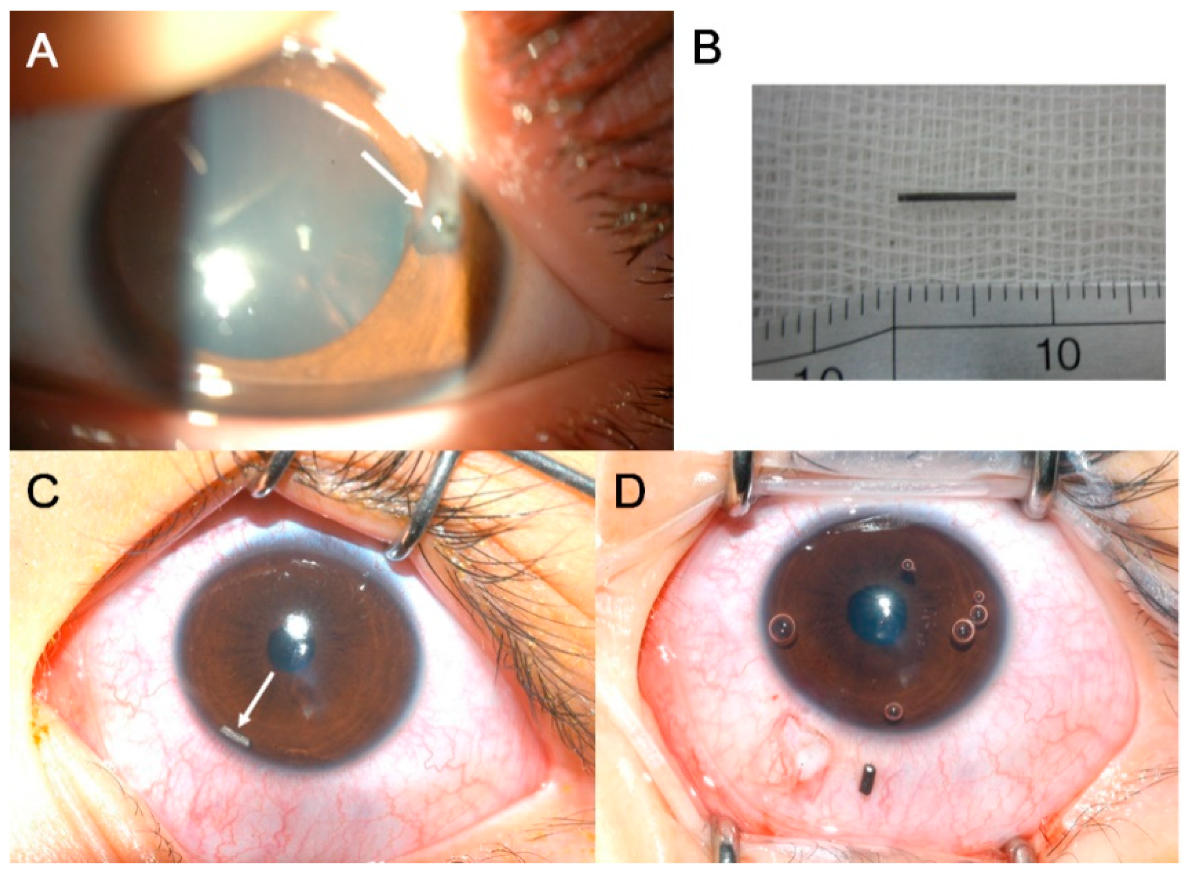 JCM Free FullText Intraocular Foreign Body Diagnostic Protocols