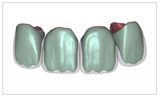 Jcm Free Full Text 3d Printing In Digital Prosthetic Dentistry An Overview Of Recent Developments In Additive Manufacturing Html