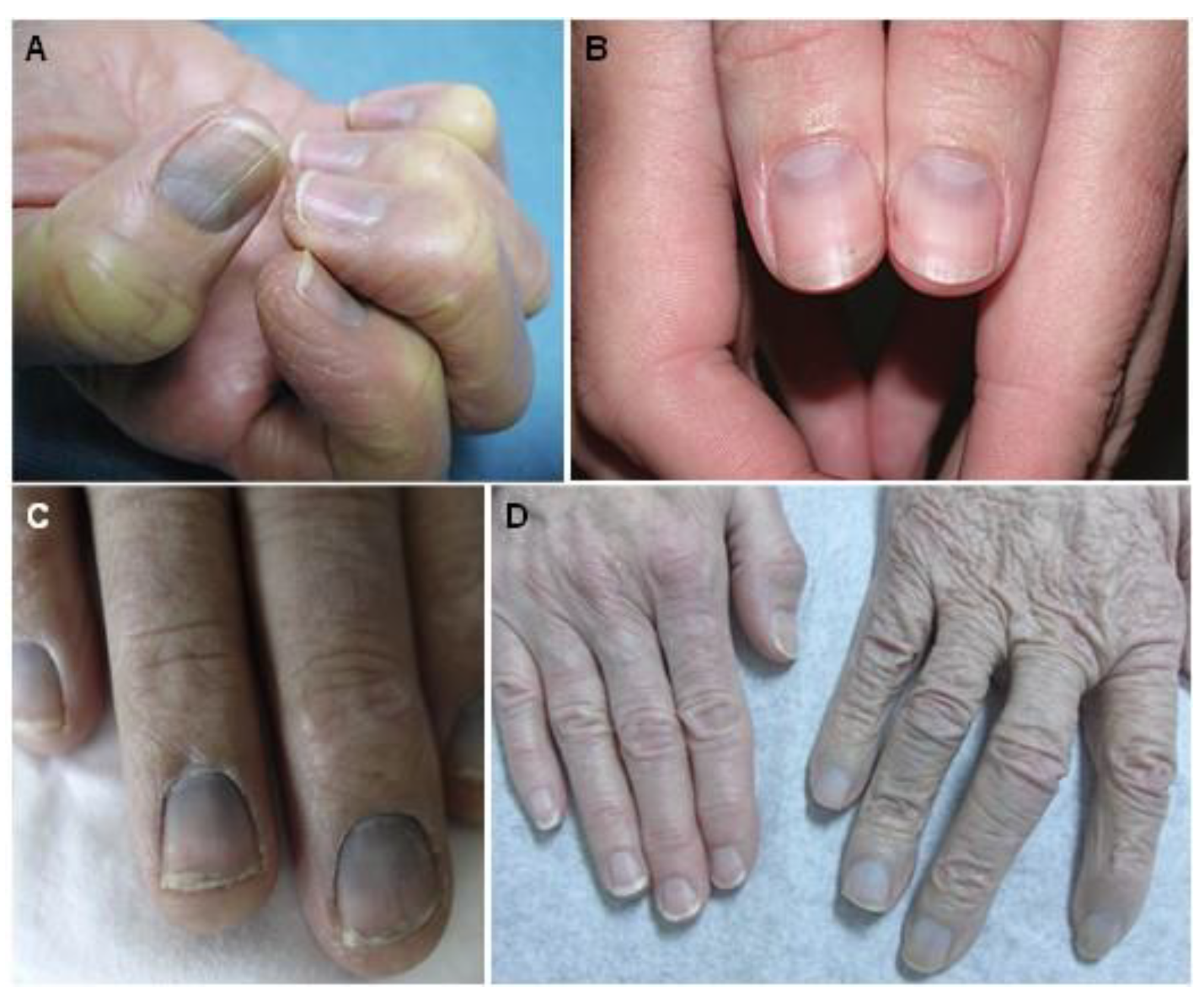 Potential Causes of Longitudinal Ridging