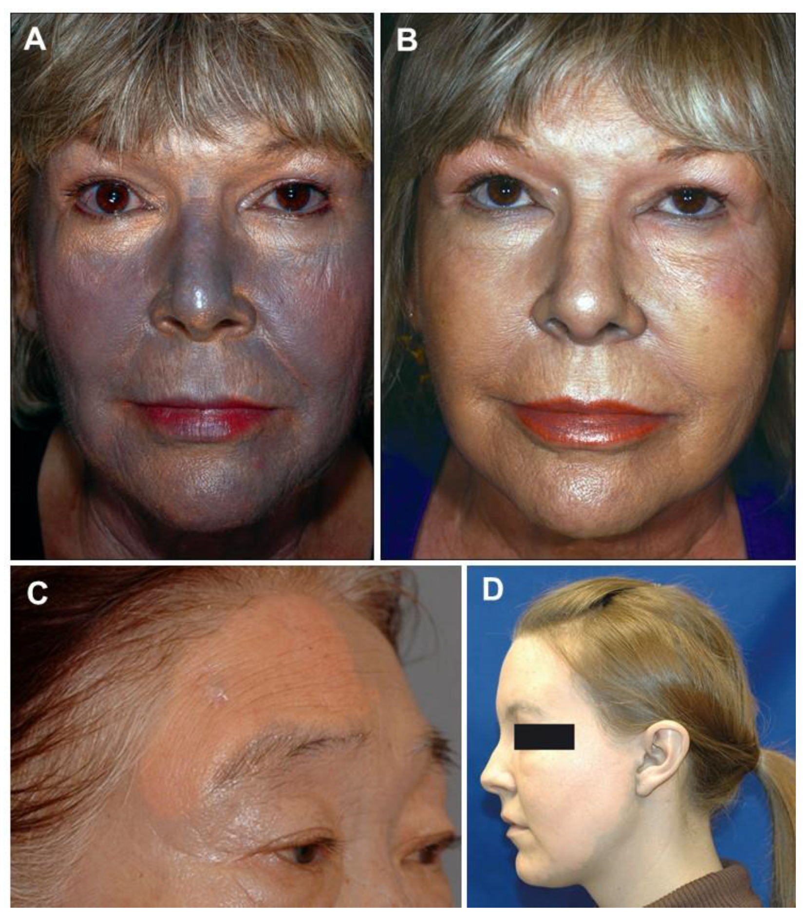 What is argyria, a condition that turns skin colour to blue?