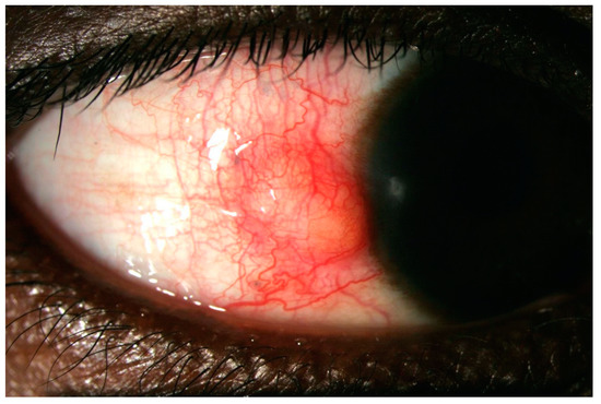 JCM | Free Full-Text | Rheumatoid Arthritis Associated Episcleritis and  Scleritis: An Update on Treatment Perspectives