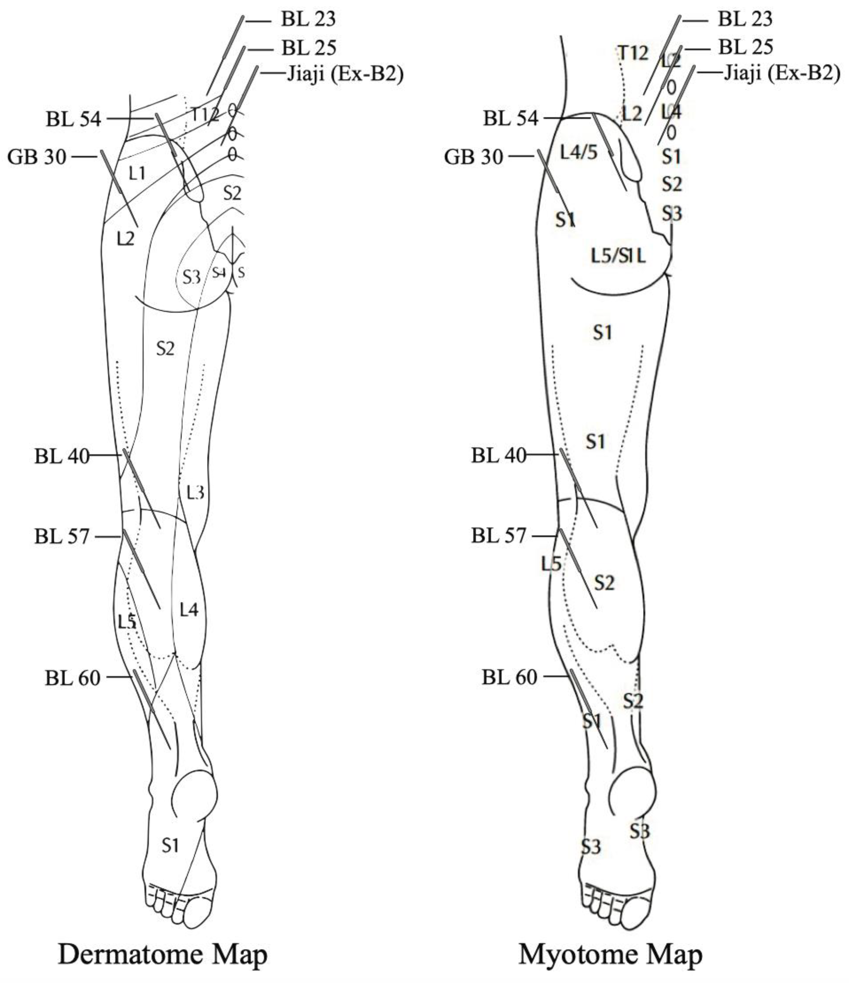 Needling Interventions for Sciatica: Choosing Methods Based