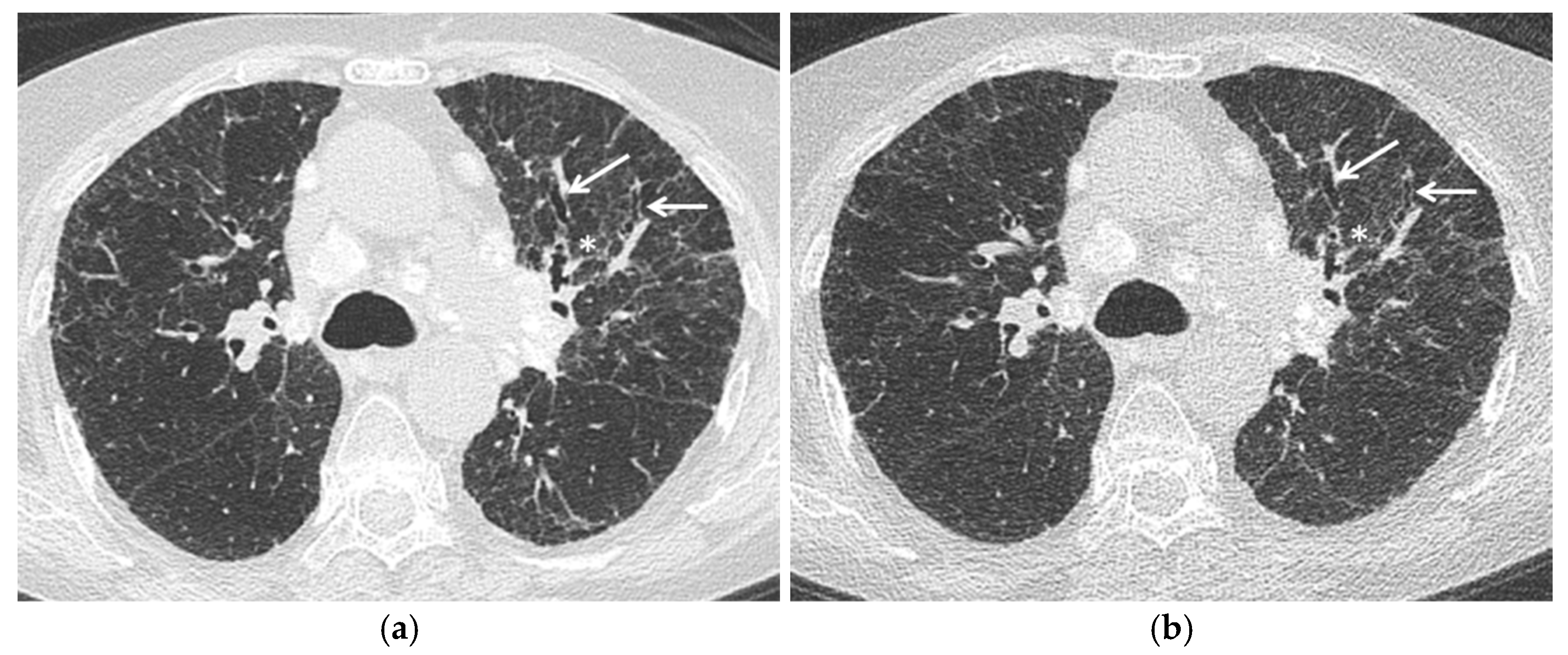 JCM Free FullText Novelties in Imaging of Thoracic Sarcoidosis