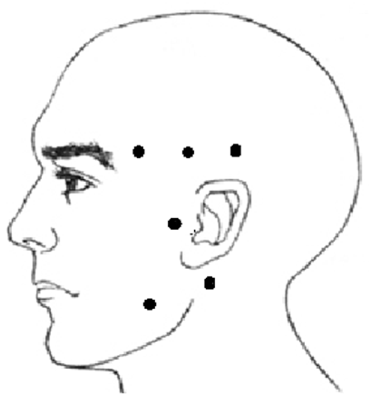 JCM Free FullText Pressure Algometry Evaluation of Two Occlusal