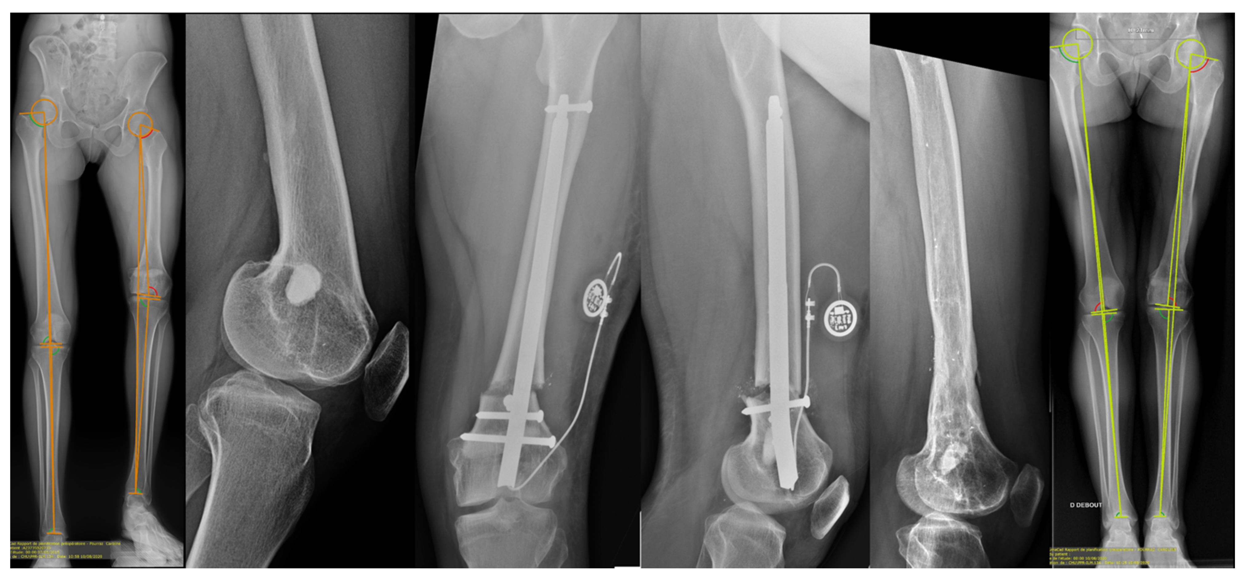 Bone Transport  International Center for Limb Lengthening