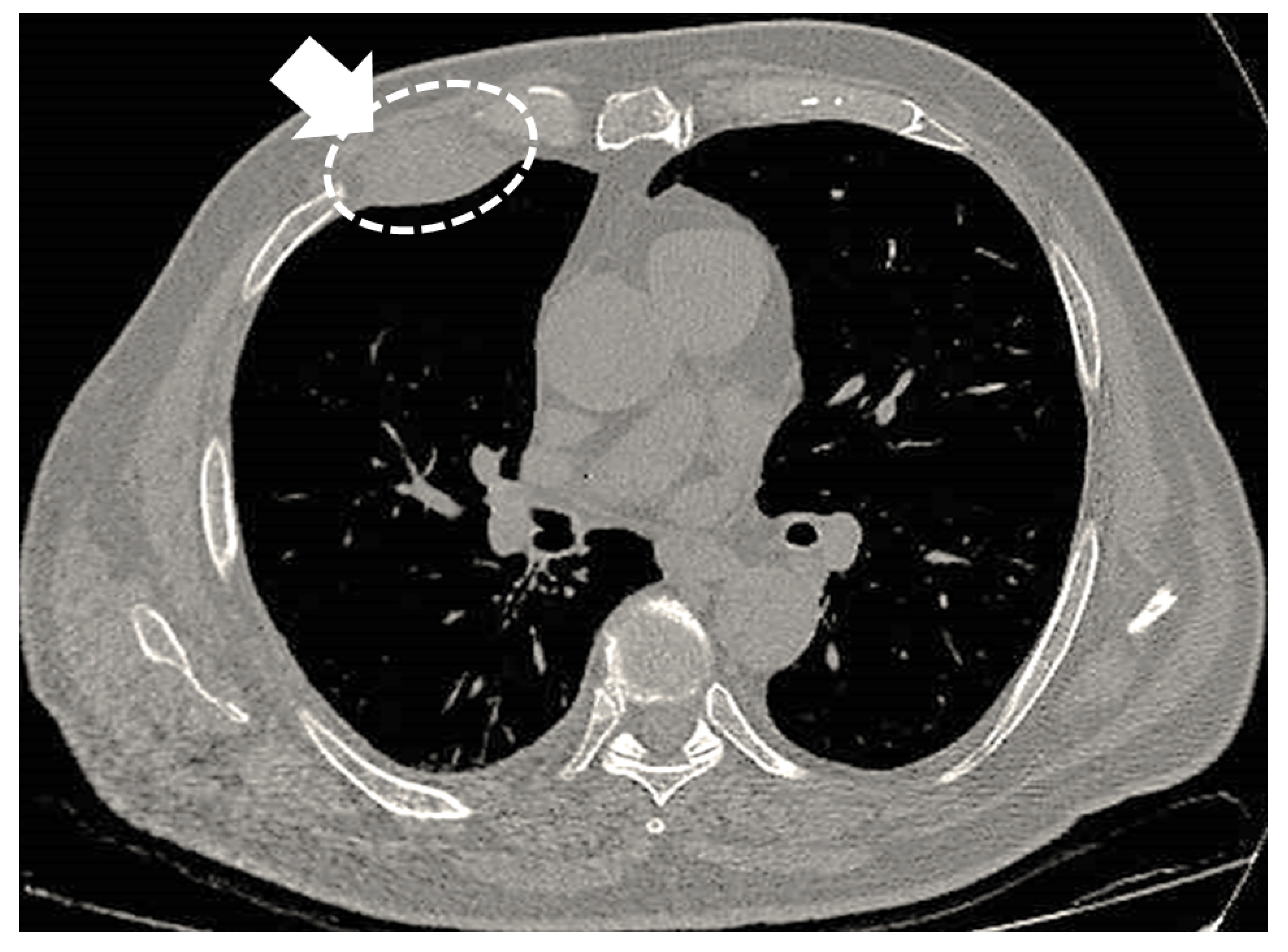 Jcm Free Full Text When The Diagnosis Of Mesothelioma Challenges Textbooks And Guidelines Html