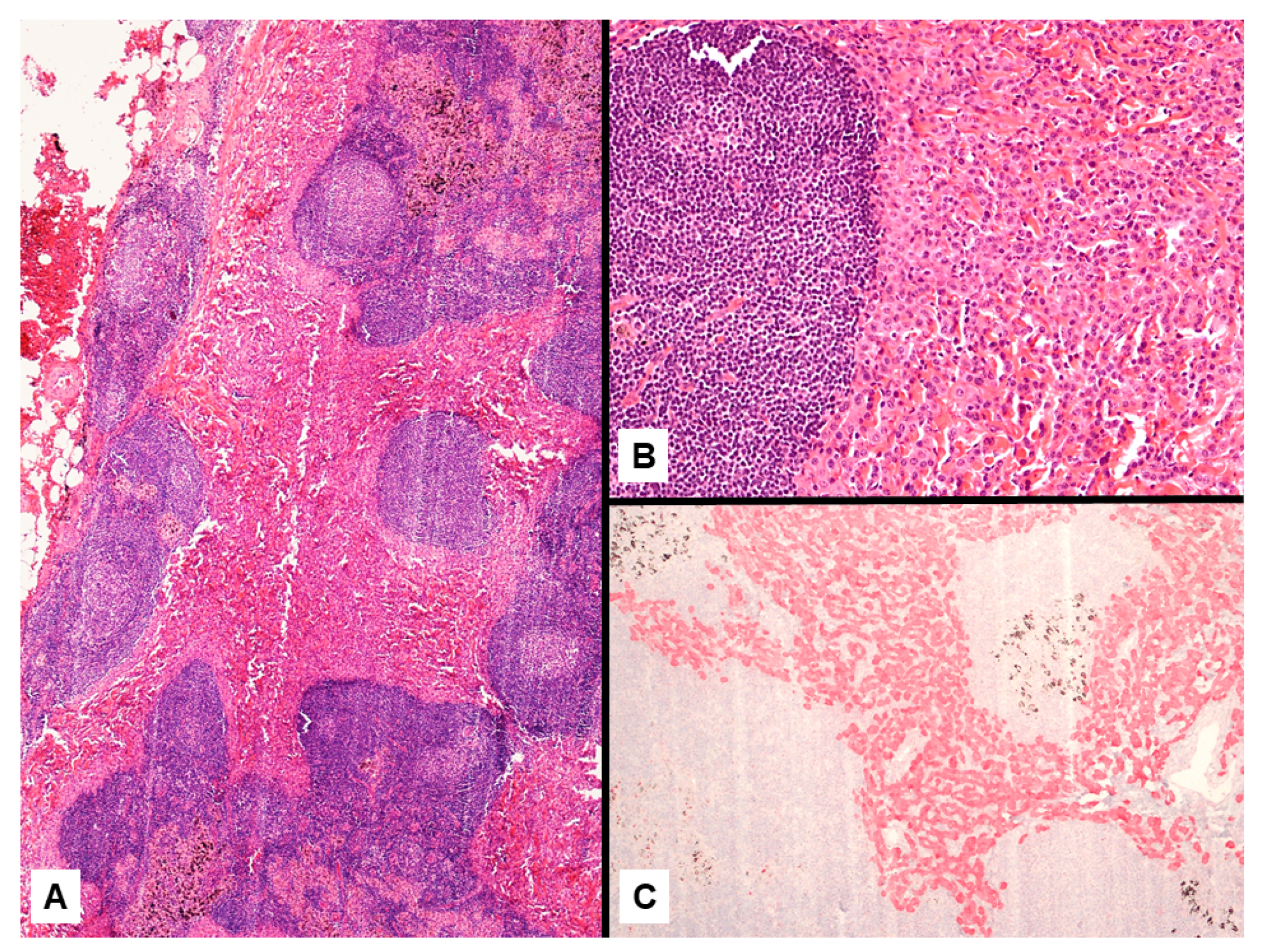 is interstitial lung disease a disability