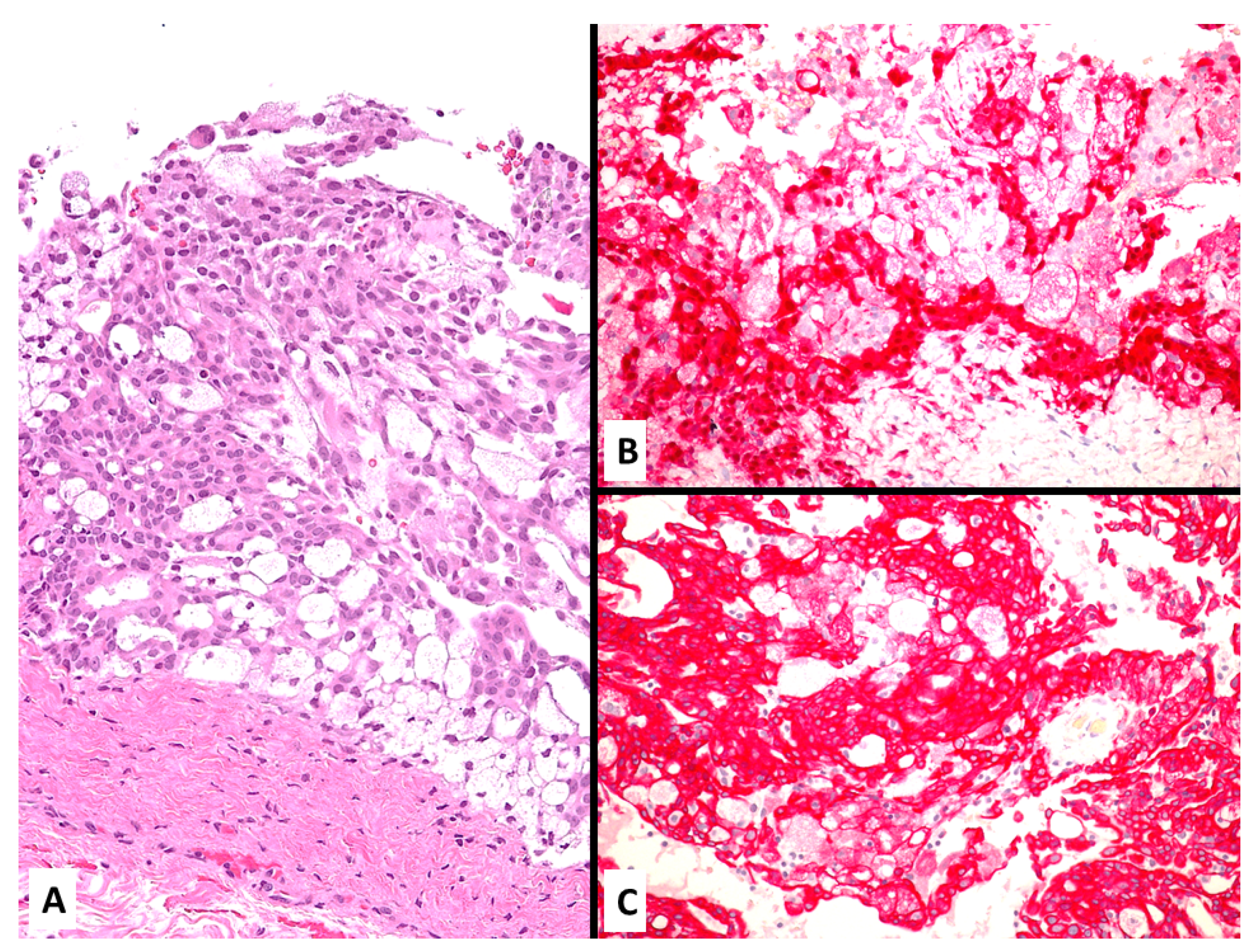 mesothelioma uterus