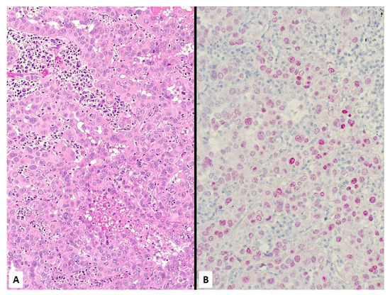 mesothelioma compensation taxable