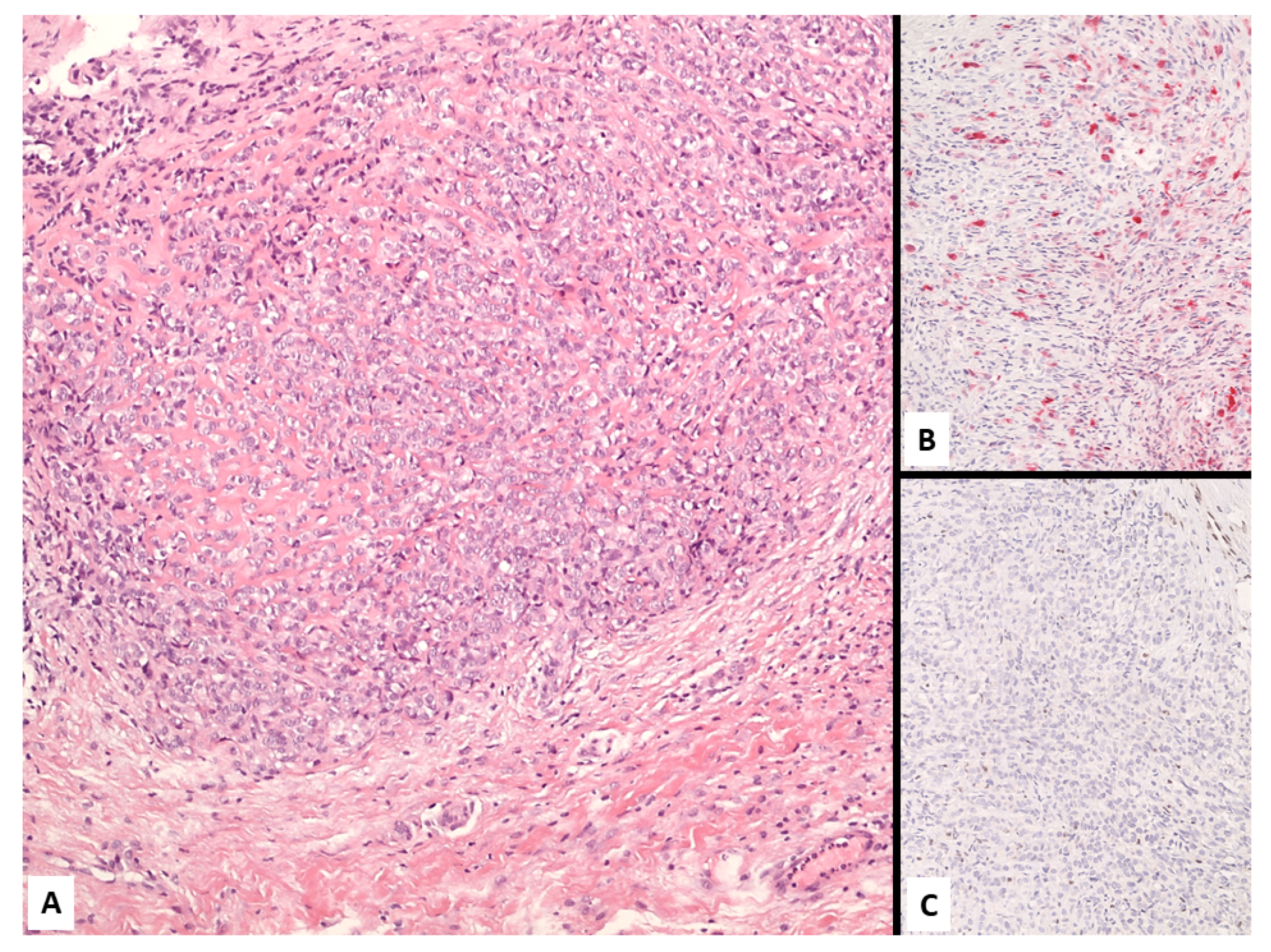 what is sarcomatoid malignant pleural mesothelioma