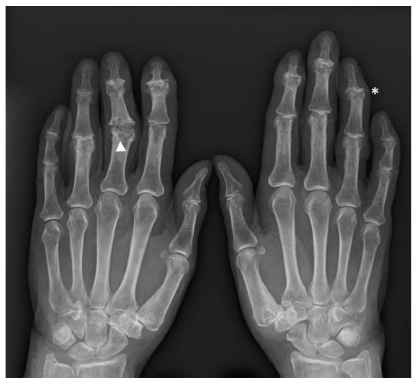 1724px x 1592px - JCM | Free Full-Text | Hand Erosive Osteoarthritis and Distal  Interphalangeal Involvement in Psoriatic Arthritis: The Place of  Conservative Therapy