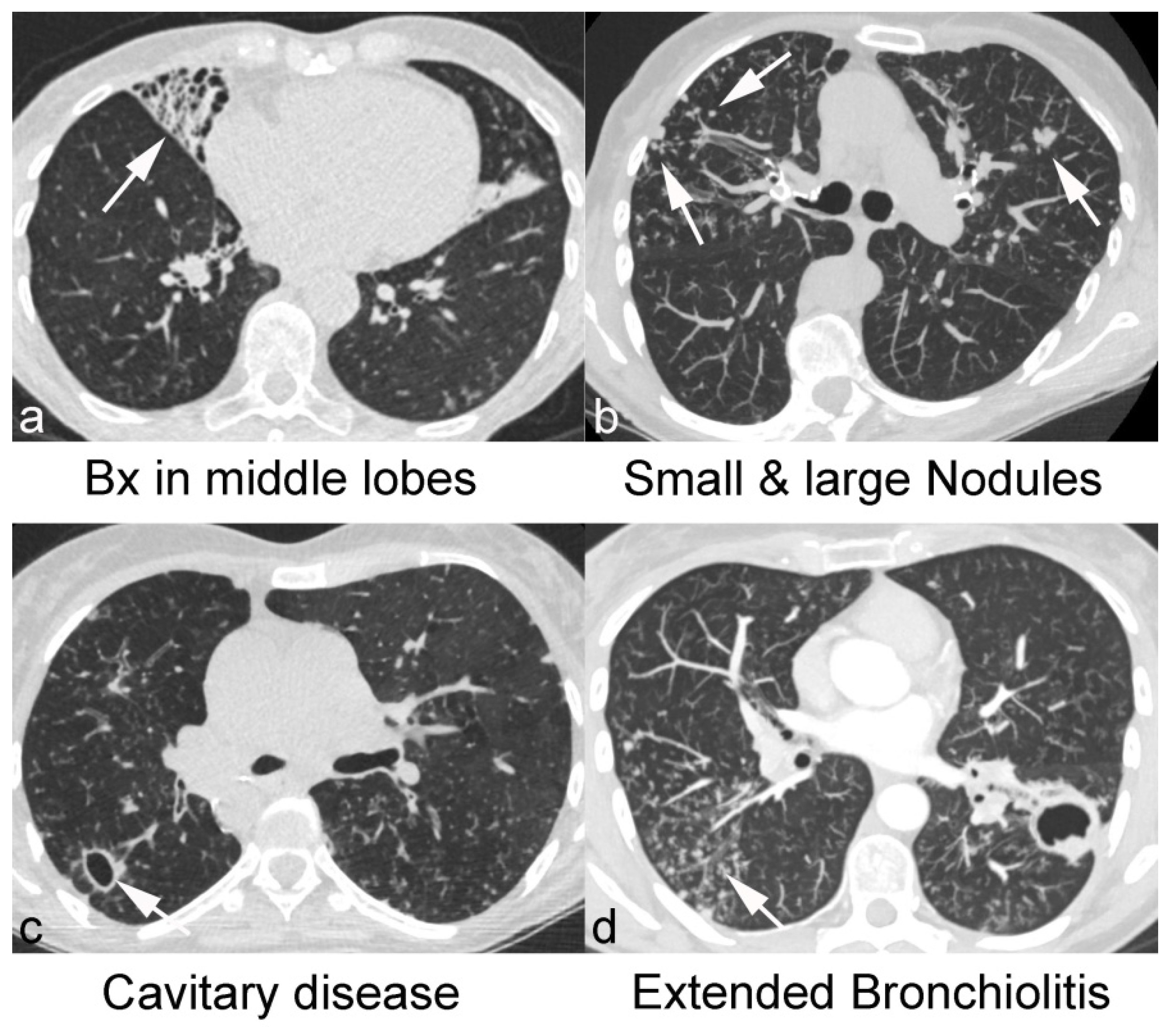 Jcm Free Full Text Computed Tomography In Adults With Bronchiectasis And Nontuberculous Mycobacterial Pulmonary Disease Typical Imaging Findings Html Jcm Free Full Text Computed Tomography In Adults With Bronchiectasis And Nontuberculous Mycobacterial Pulmonary Disease Typical Imaging Findings Html