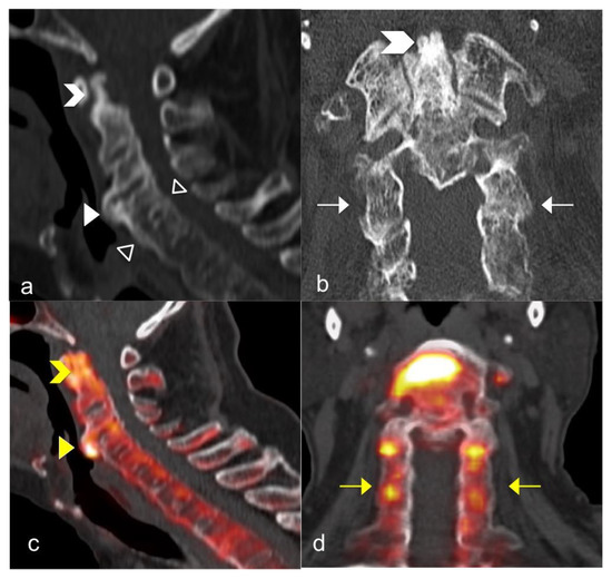 Psa Back Axial Psoriatic Disease: Clinical and Imaging Assessment of an ...