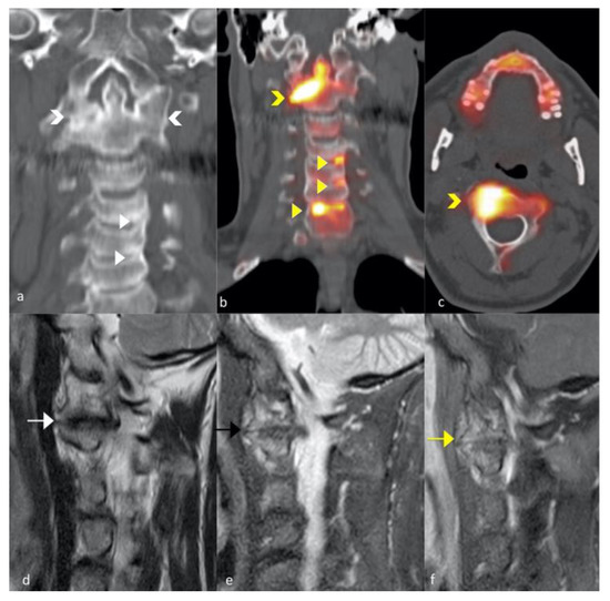 Psa Back Axial Psoriatic Disease: Clinical and Imaging Assessment of an ...
