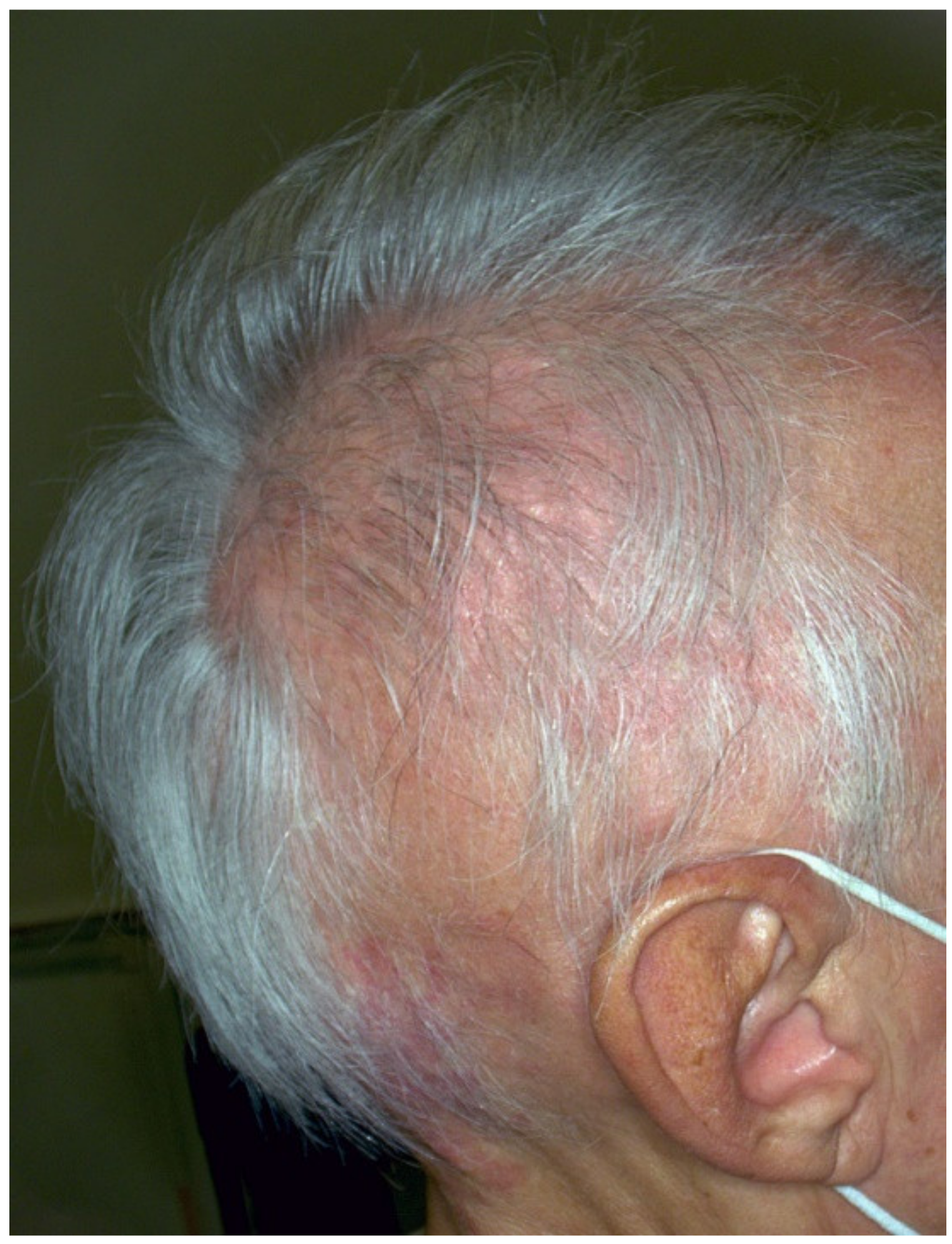 Diffuse Melanosis Cutis