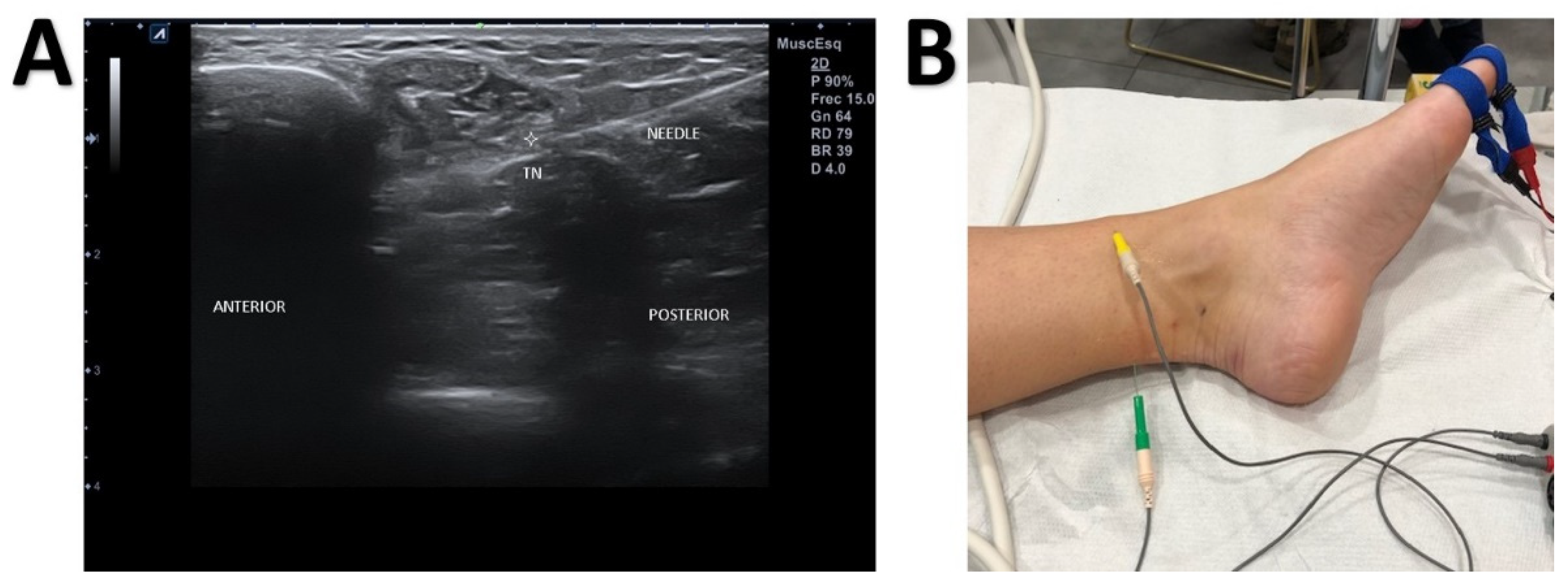 JCM Free FullText UltrasoundGuided NearNerve Needle Sensory