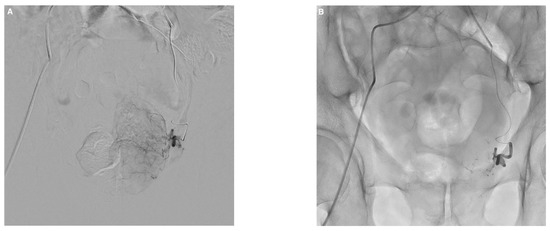 Prostatitis és fistula)