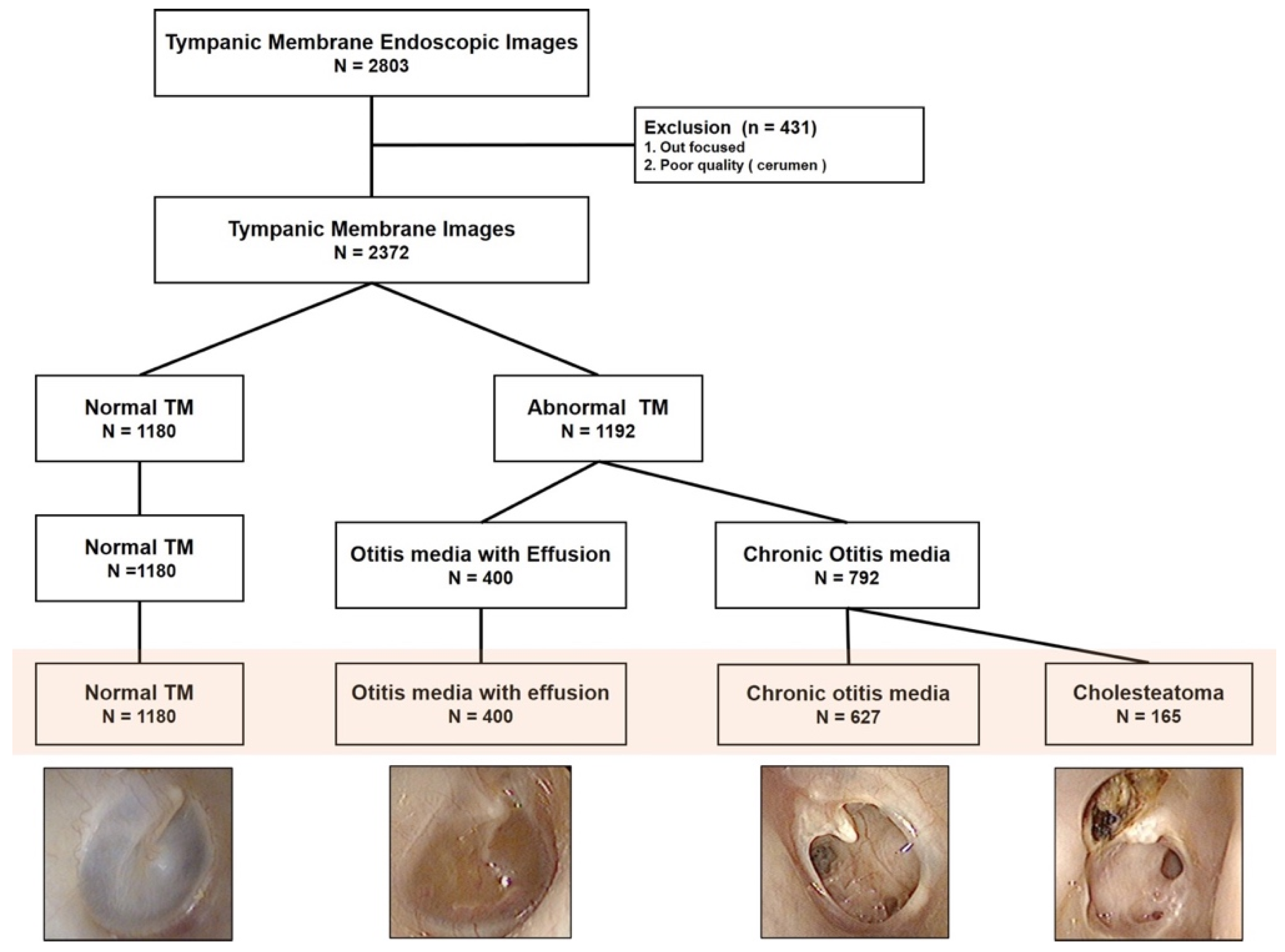 Tympanic Membrane Otitis Media Effusion