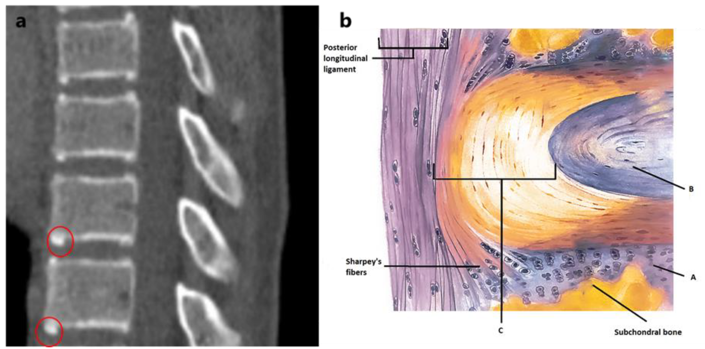 JCM Free FullText Ossification and Fusion of the Vertebral Ring Apophysis as an Important