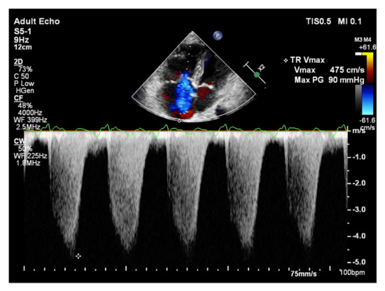 Echocardiography in Pulmonary Arterial Hypertension