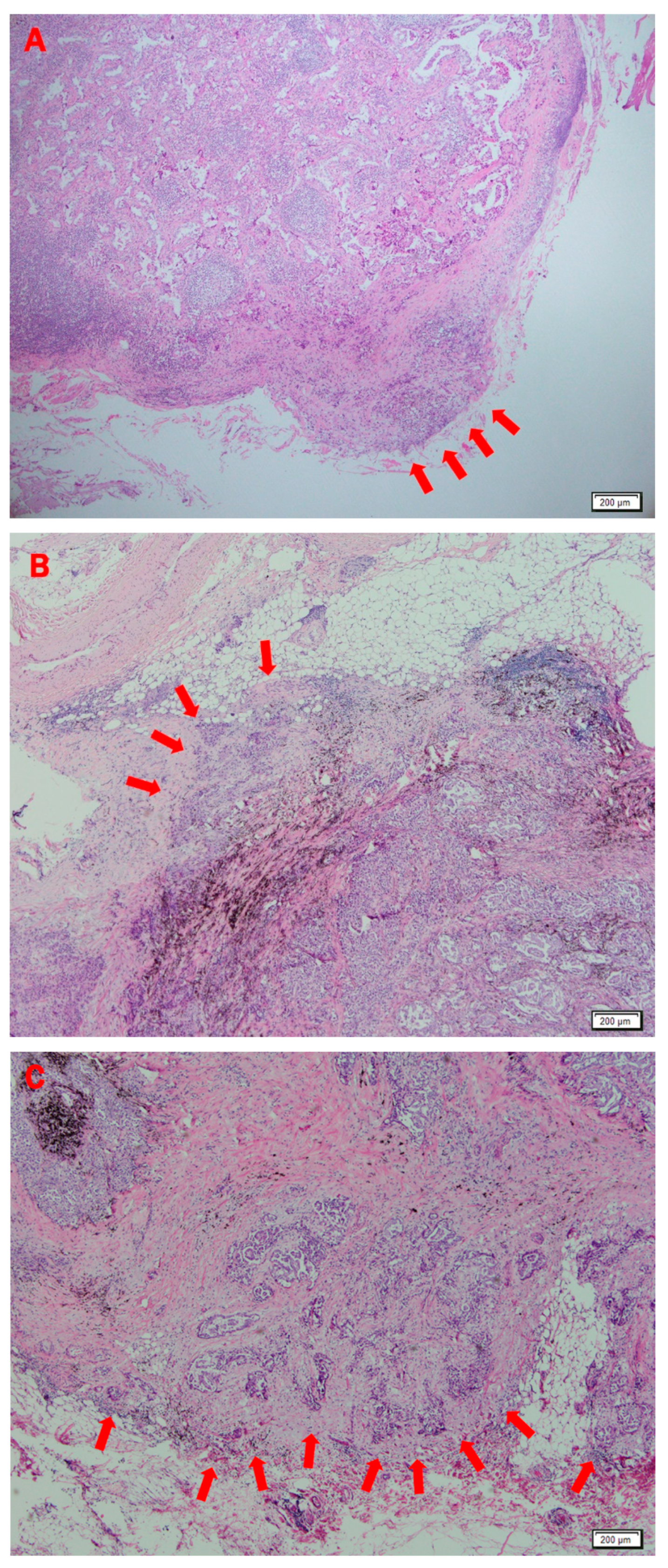 Prognostic Significance of the Extranodal Extension of