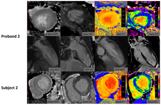 The Value of Cardiac Magnetic Resonance Imaging in Identification of ...