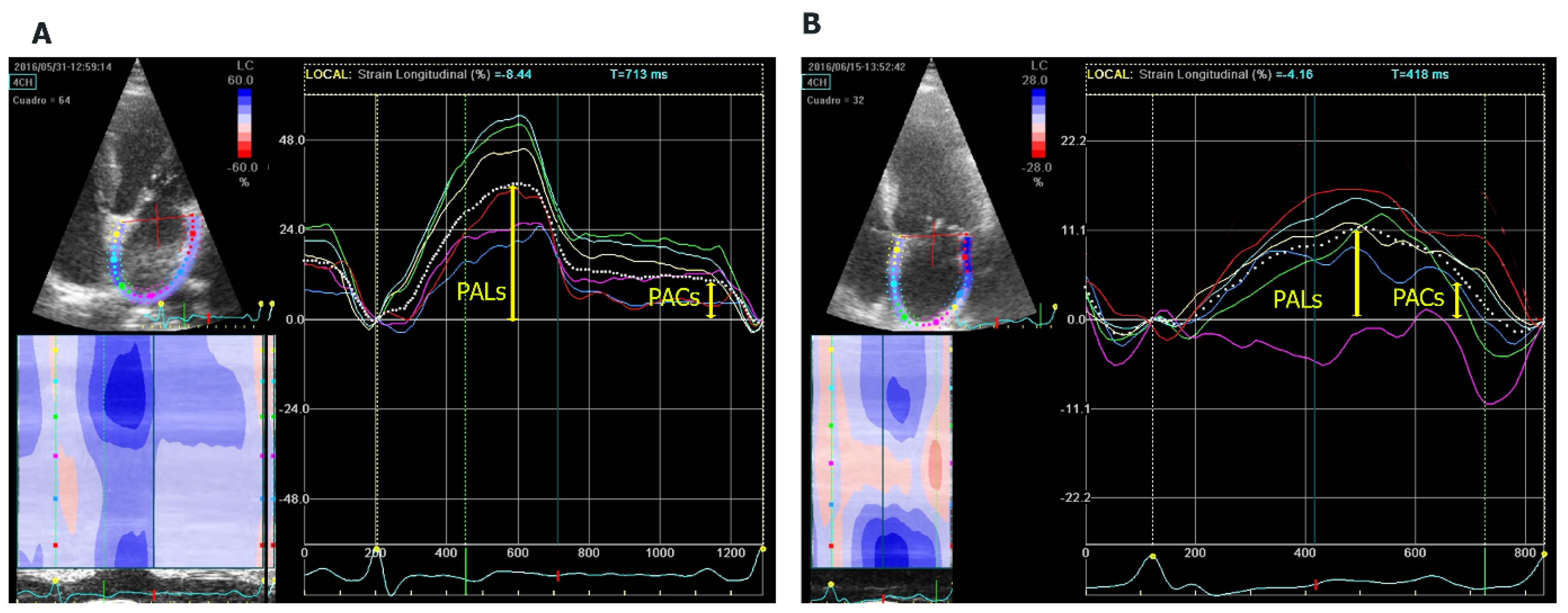 Two-dimensional speckle tracking echocardiography for the assessment of  atrial function