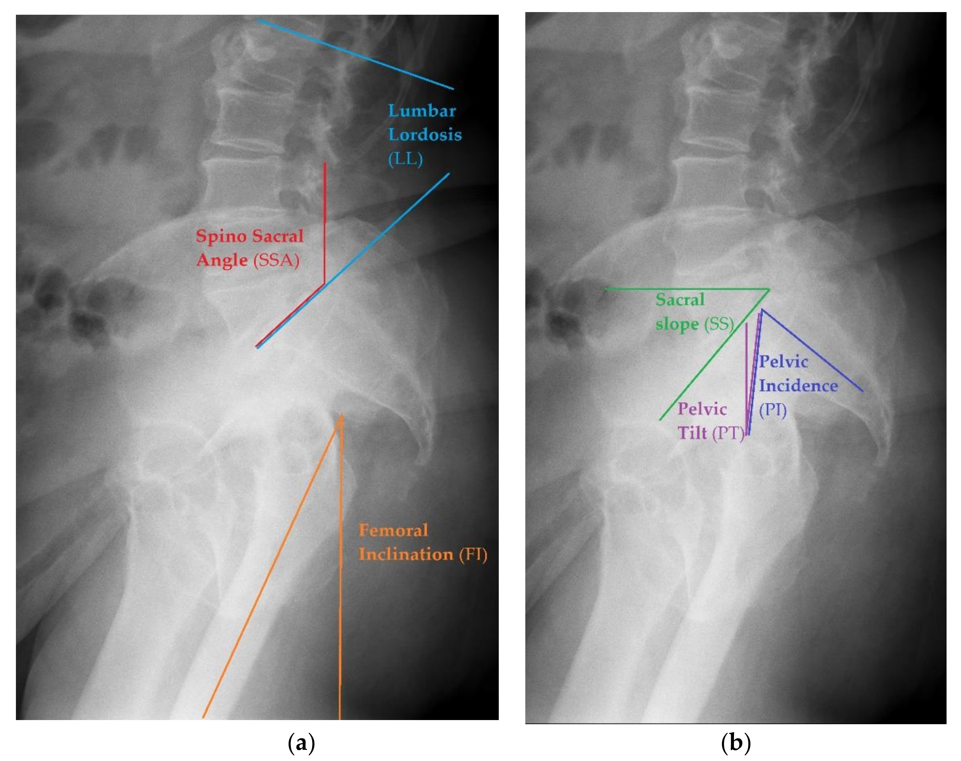 sacrum anatomy xray