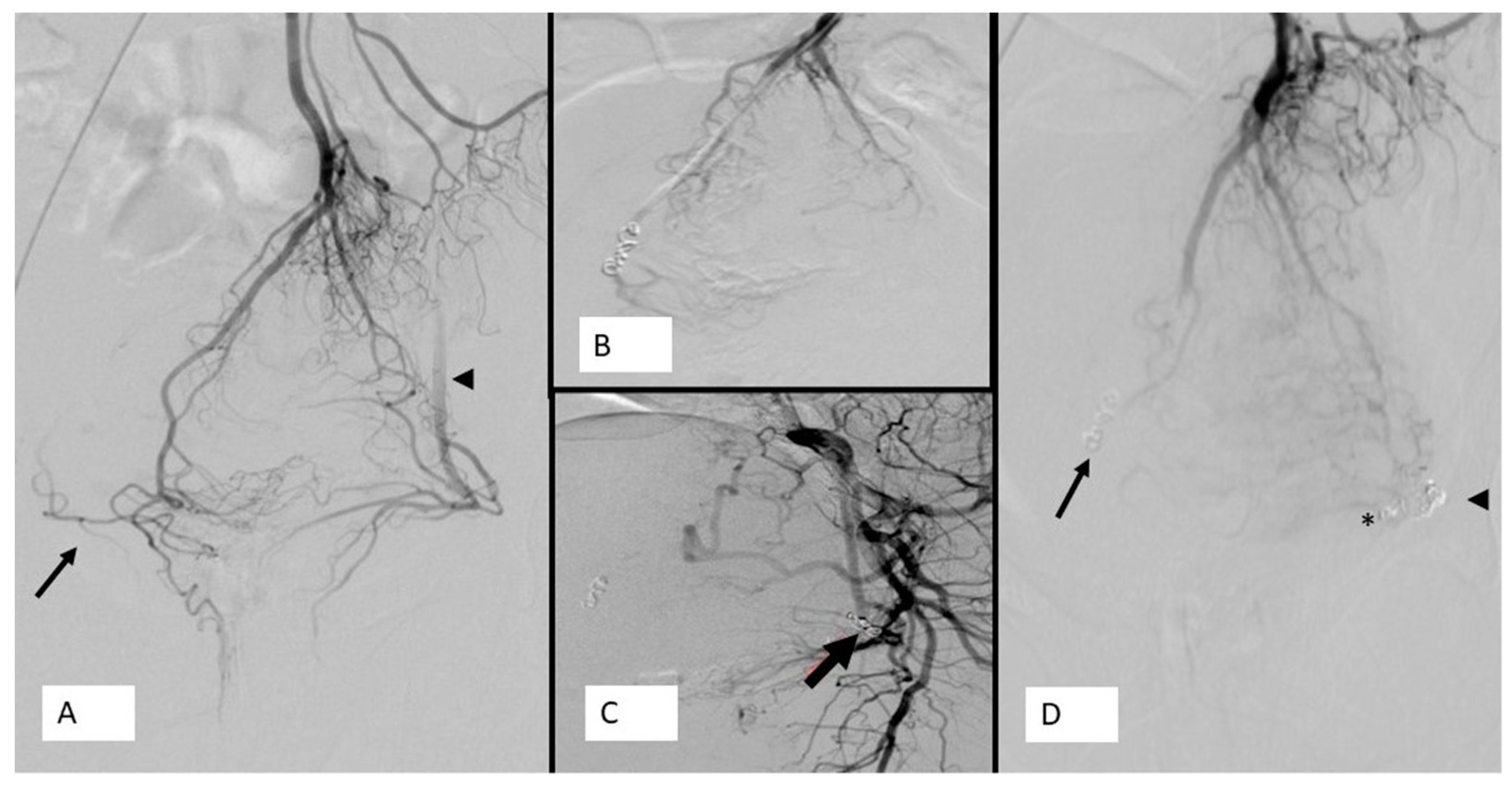 JCM Free FullText Hemorrhoids Embolization State of the Art and