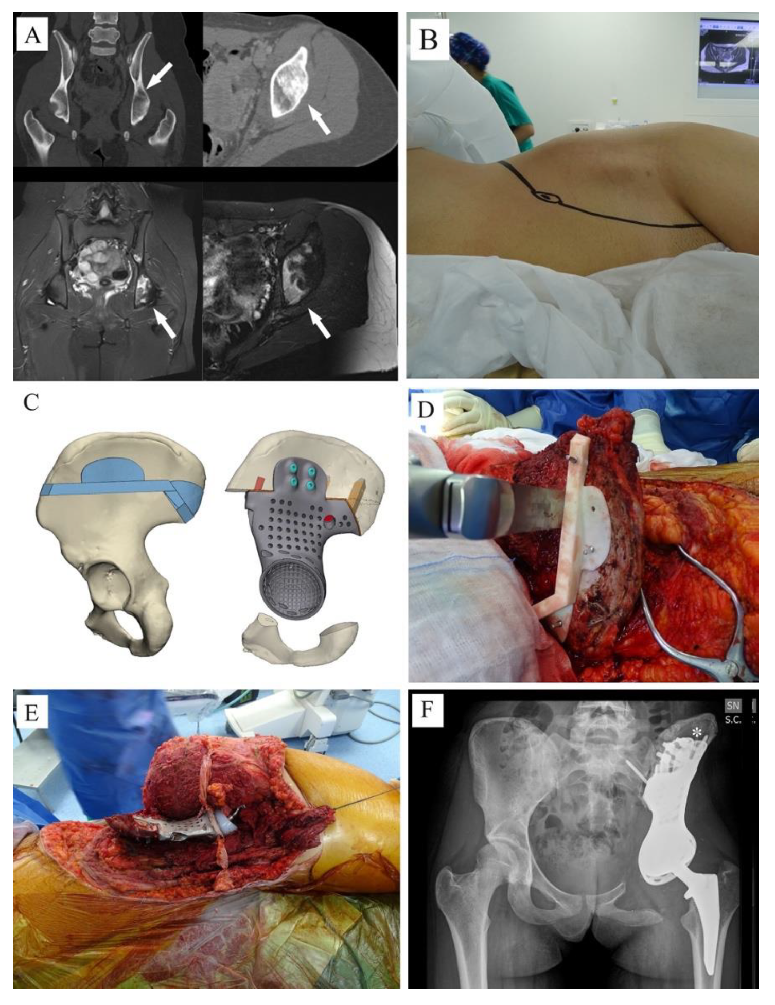 3D-Printed Titanium Custom-Made Prostheses in Reconstruction
