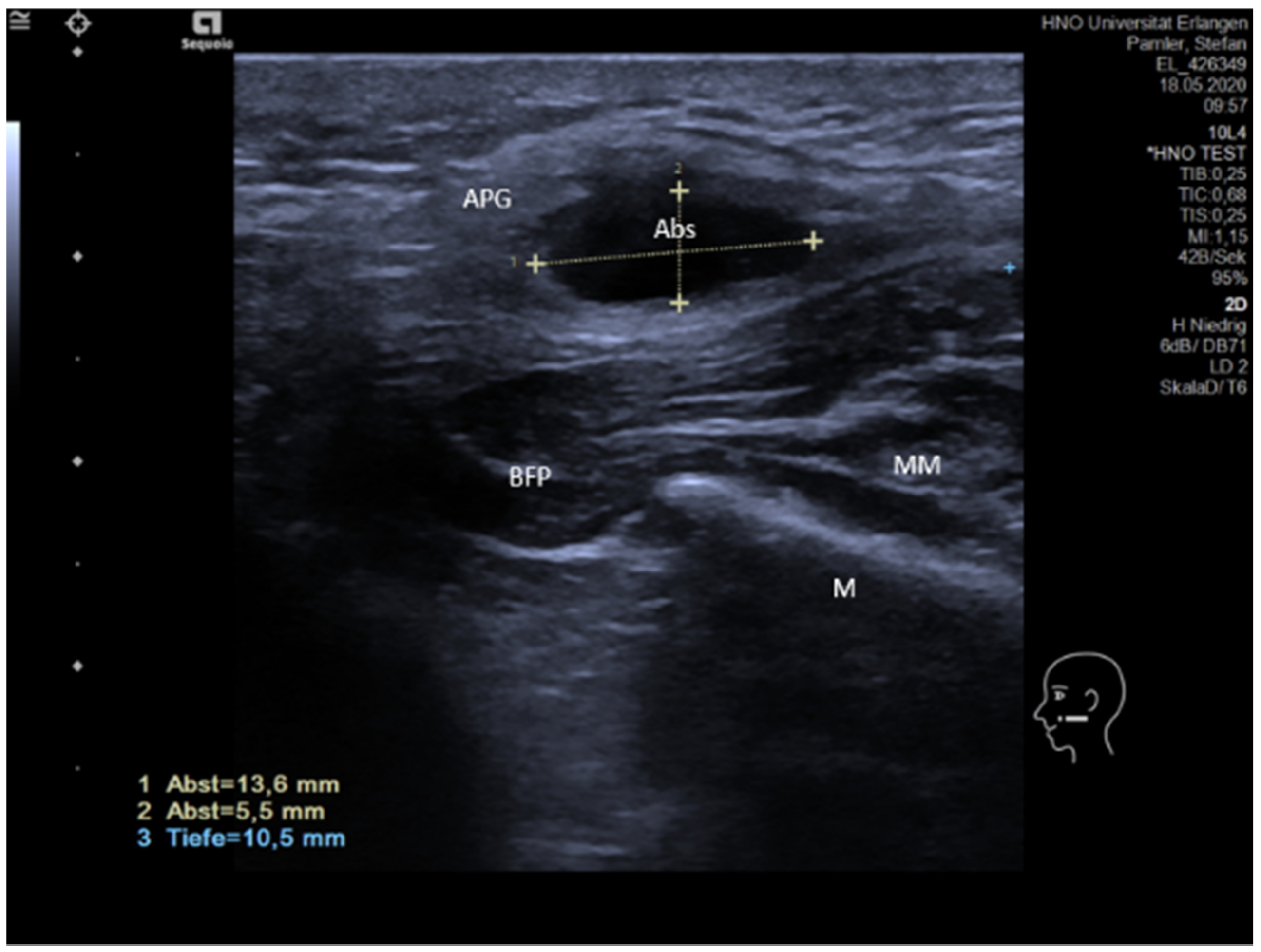 parotid gland tumor ultrasound