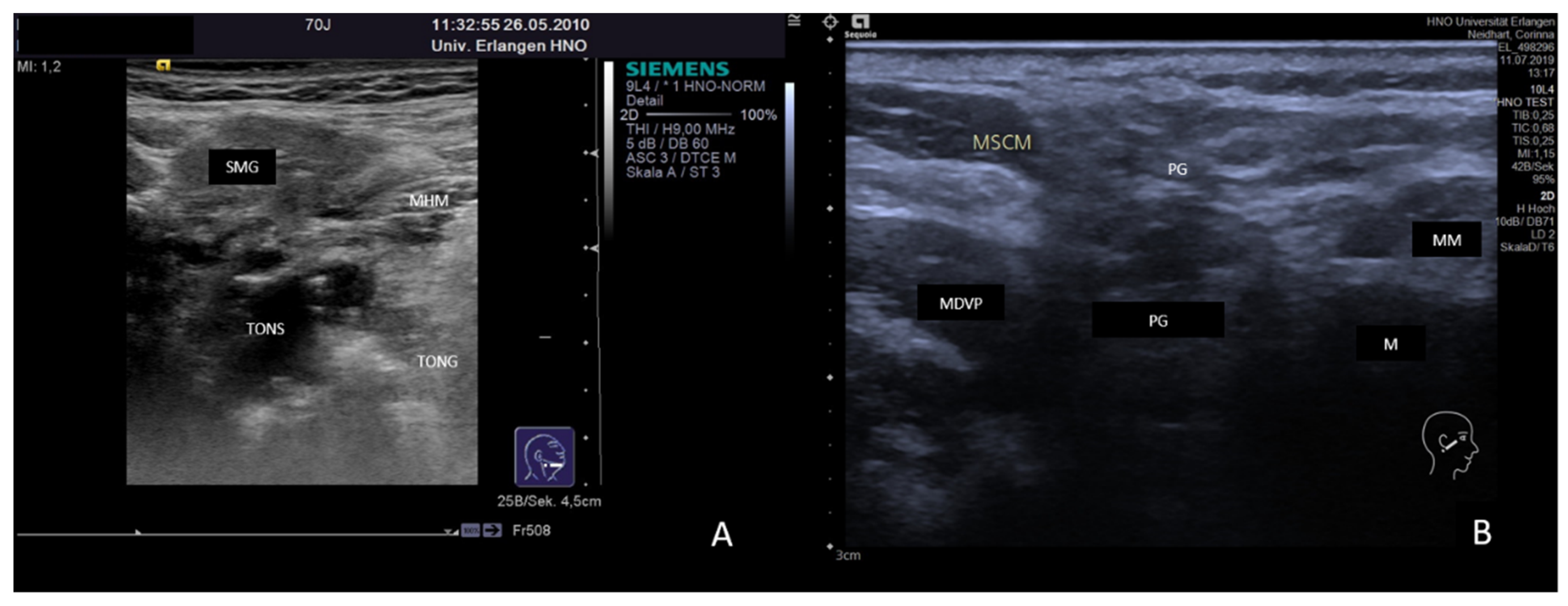 parotid gland tumor ultrasound