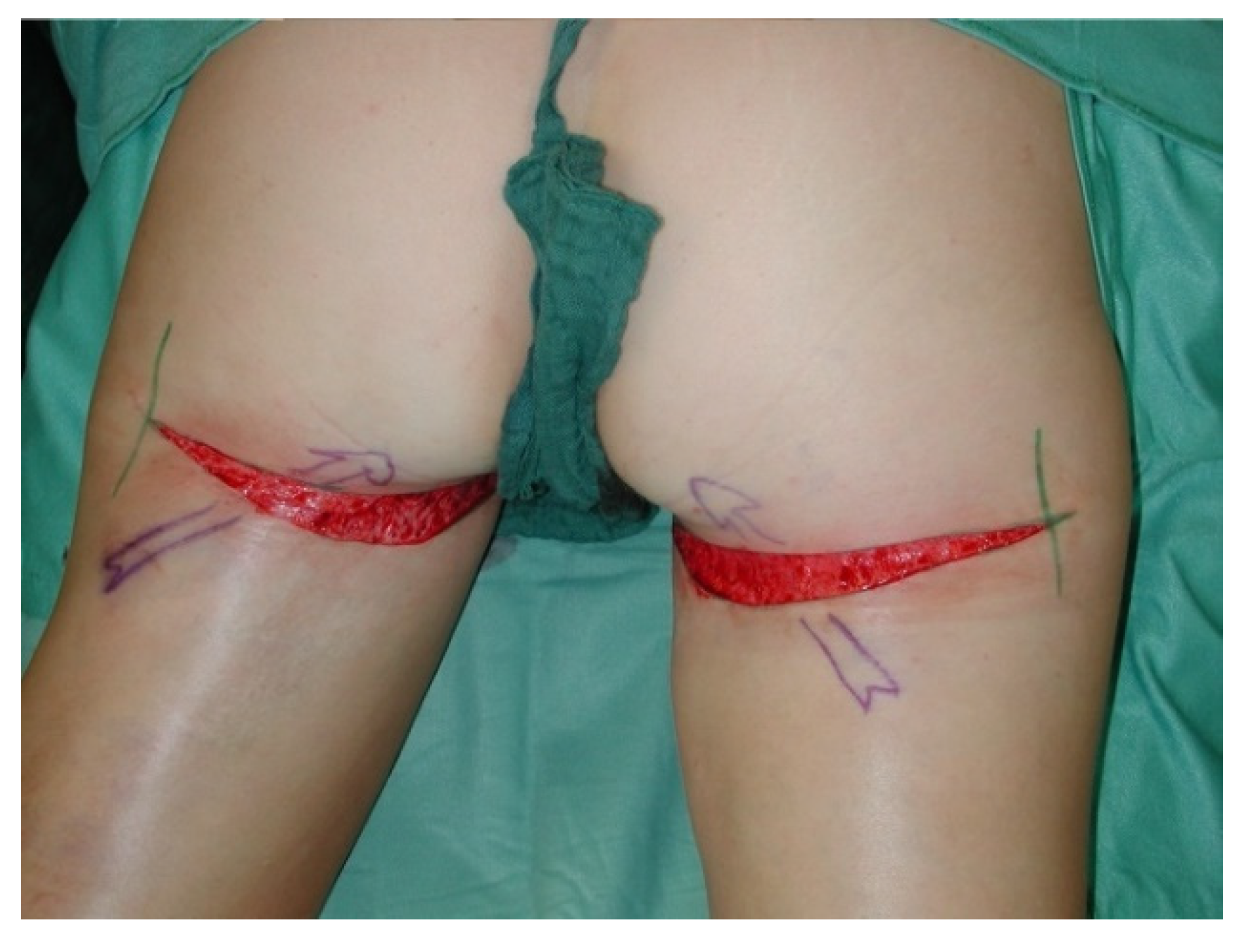 Thigh scar in breast reconstruction surgery - Stock Image - C038/2383 -  Science Photo Library