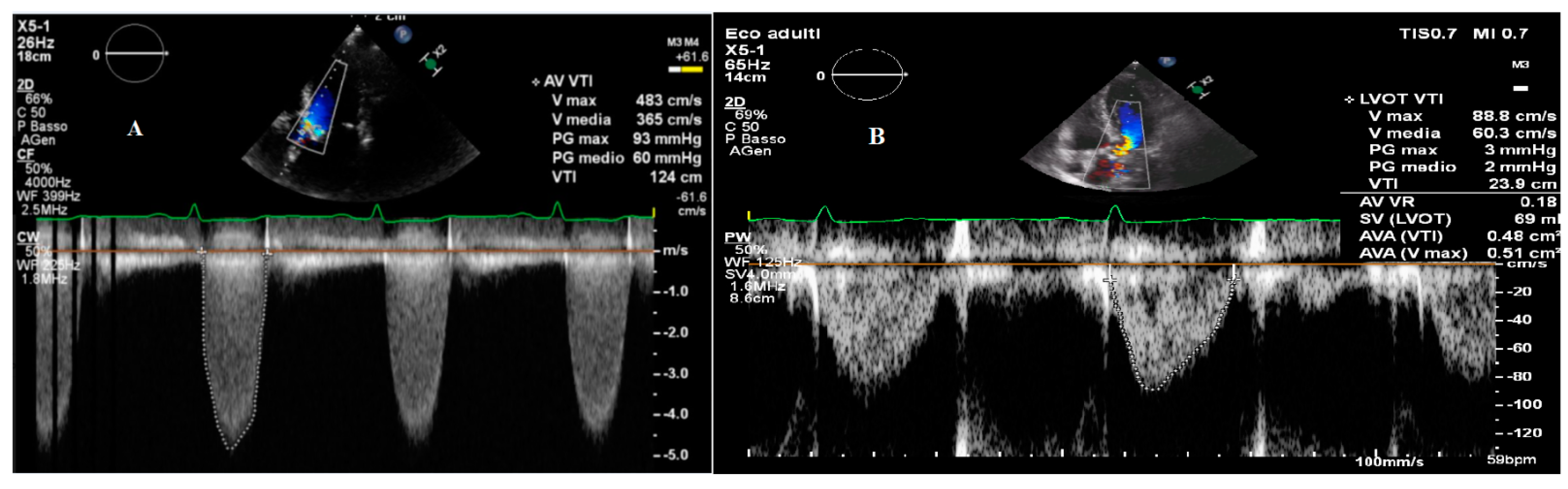 Clinical Applications of Strain Imaging in Aortic Valve Disease