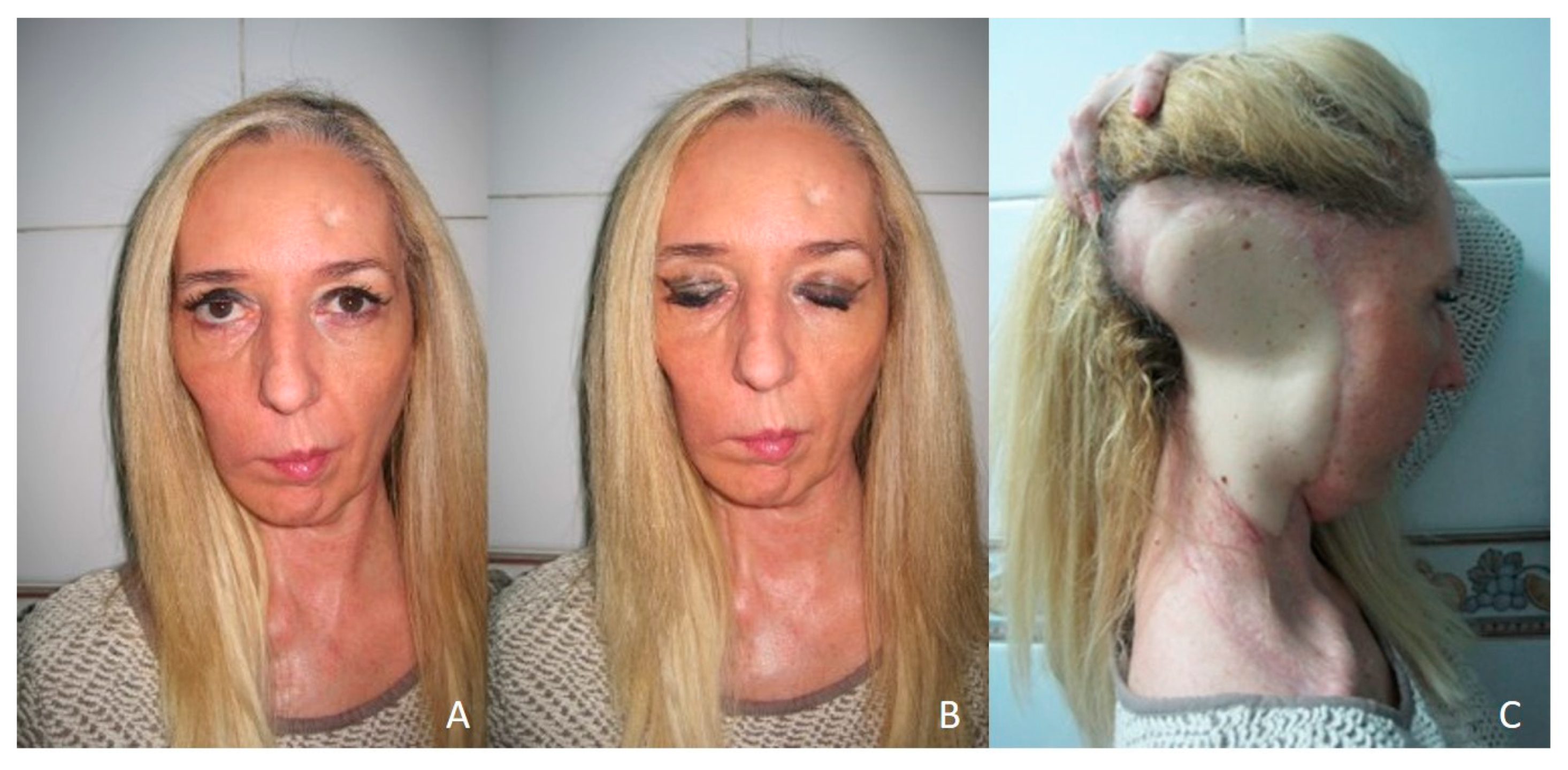 JCM | Free Full-Text | Clinical and Surgical Outcomes in Extensive Scalp  Reconstruction after Oncologic Resection: A Comparison of Anterolateral  Thigh, Latissimus Dorsi and Omental Free Flaps