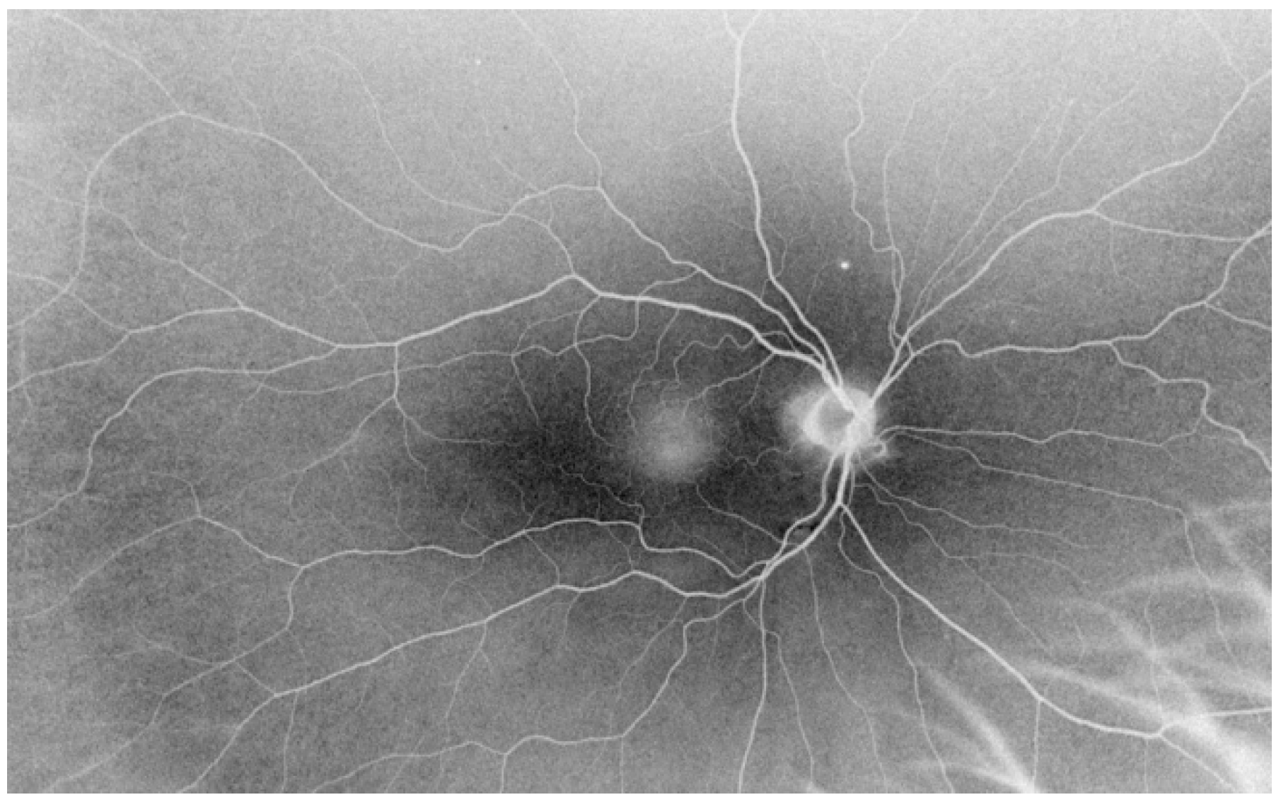 Ultra-wide fundus photograph (UWFP) and optical coherence
