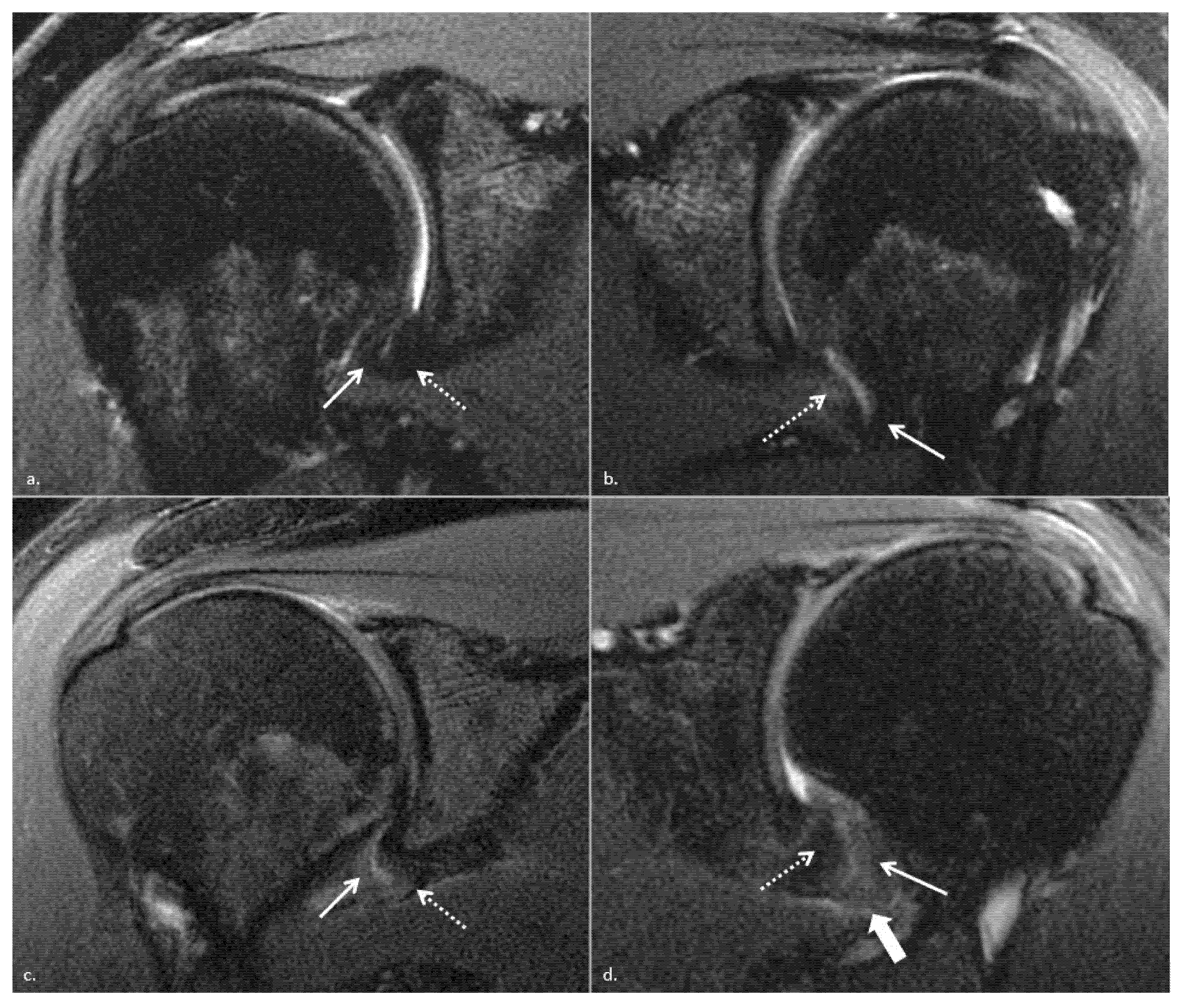 JCM Free FullText MR Imaging Biomarkers for Clinical Impairment