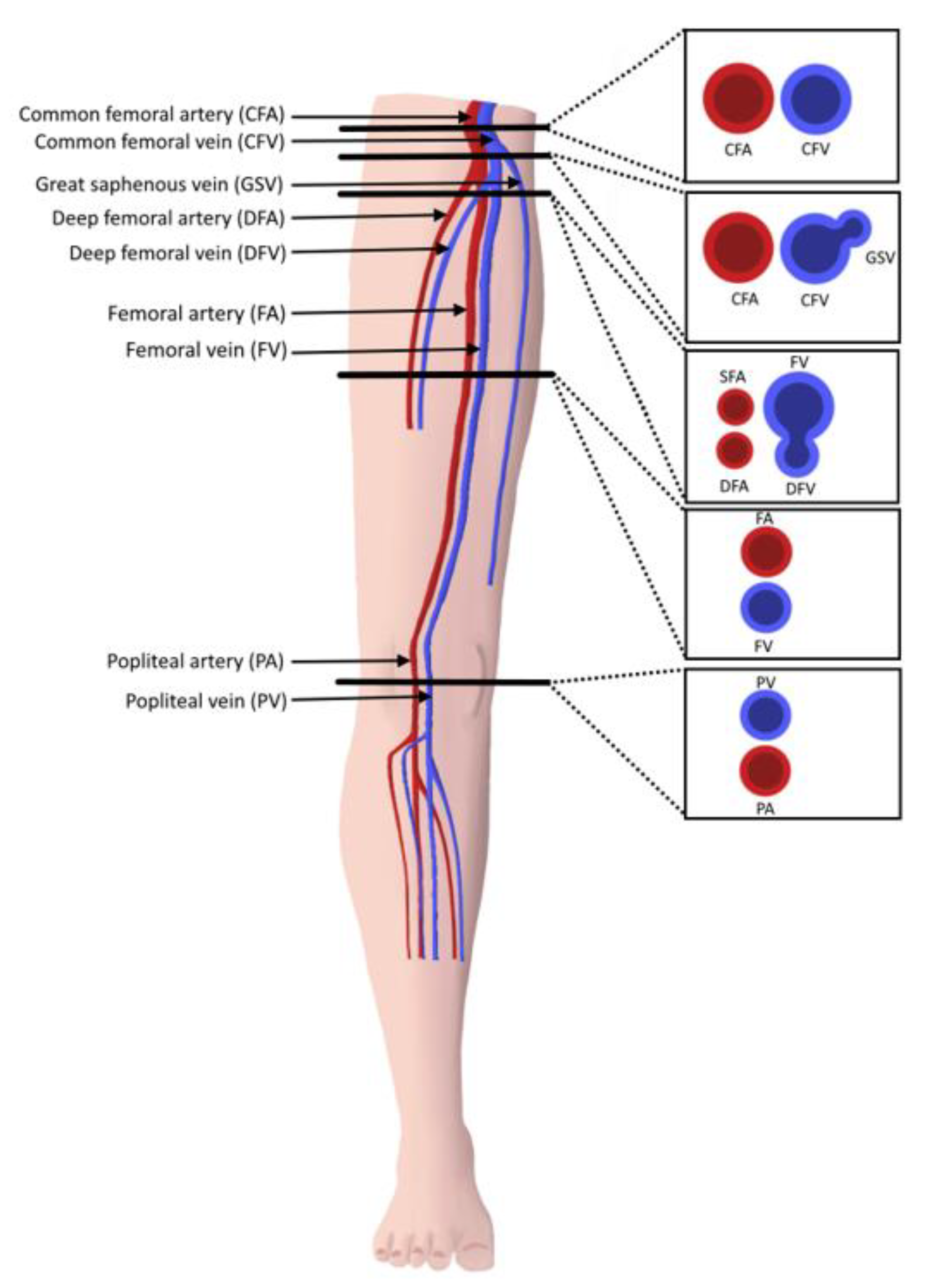blood clot in leg ultrasound