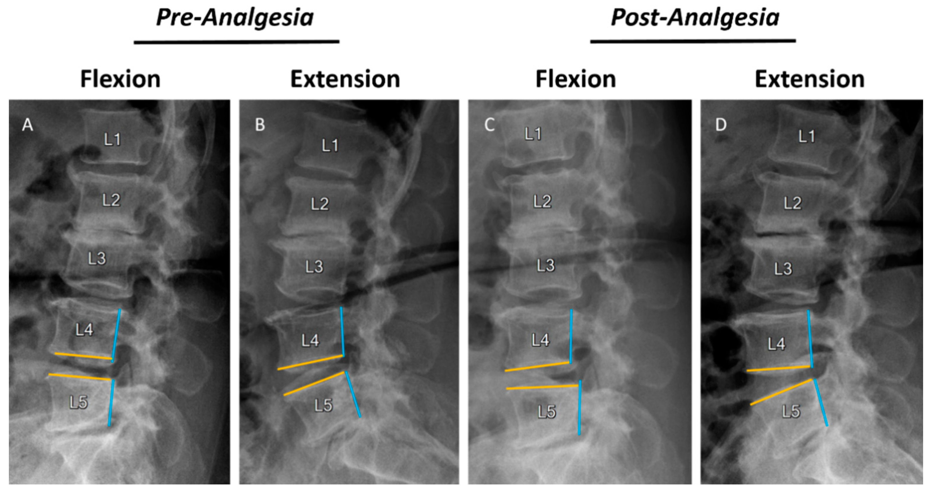 Flexion Extension Lumbar Spine X Ray My XXX Hot Girl