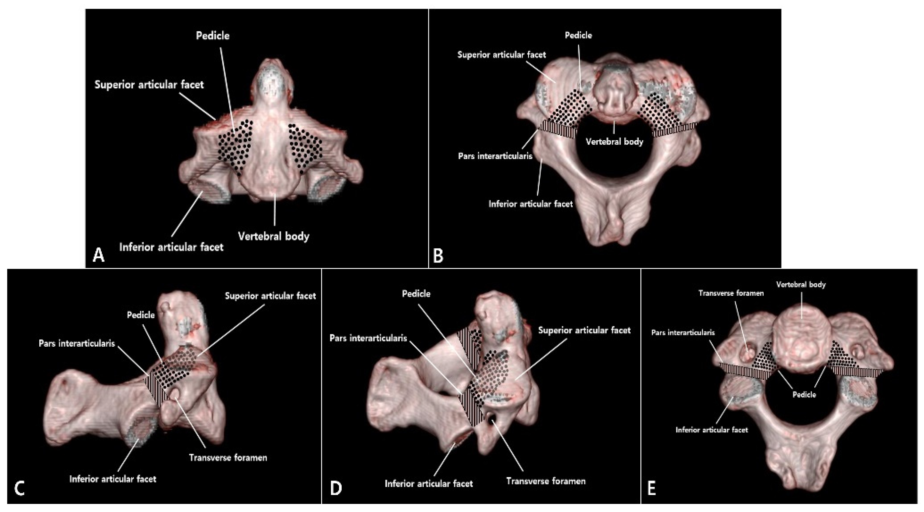 JCM | Free Full-Text | Proposal of Treatment Strategy for Pedicle Fractures  of the C2: An Analysis of 49 Cases
