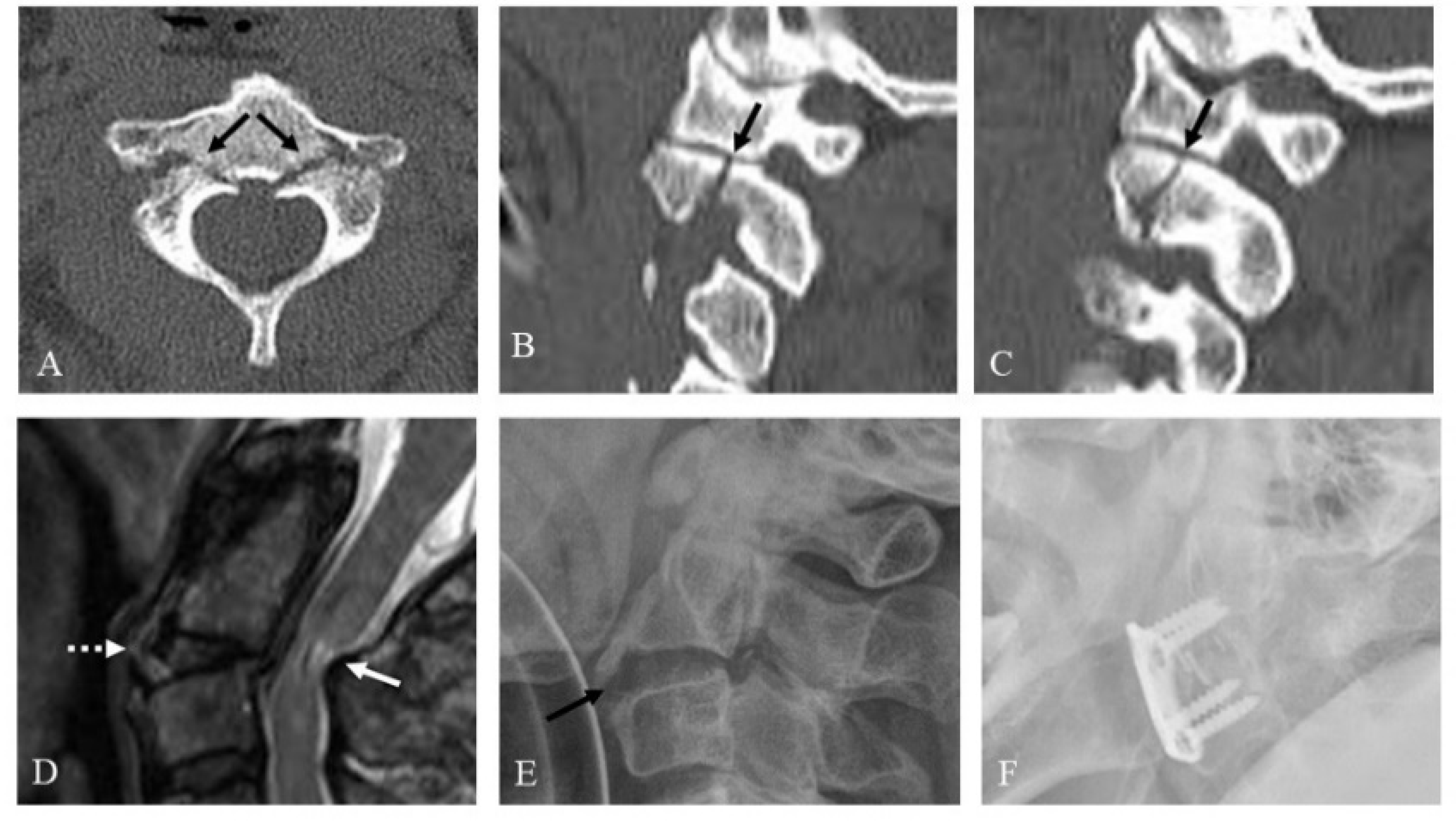JCM | Free Full-Text | Proposal of Treatment Strategy for Pedicle Fractures  of the C2: An Analysis of 49 Cases