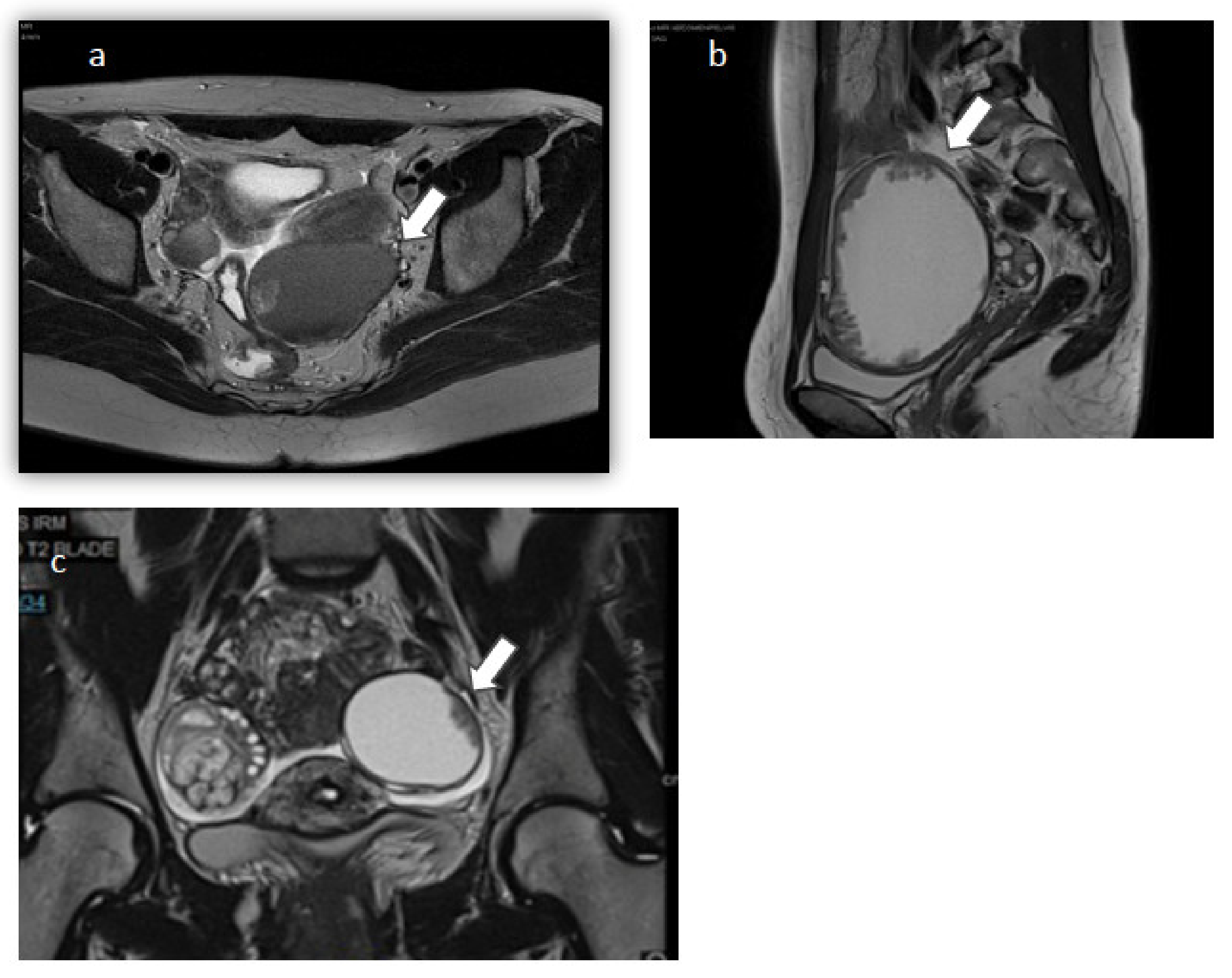 Eight patients with borderline tumour who developed recurrence