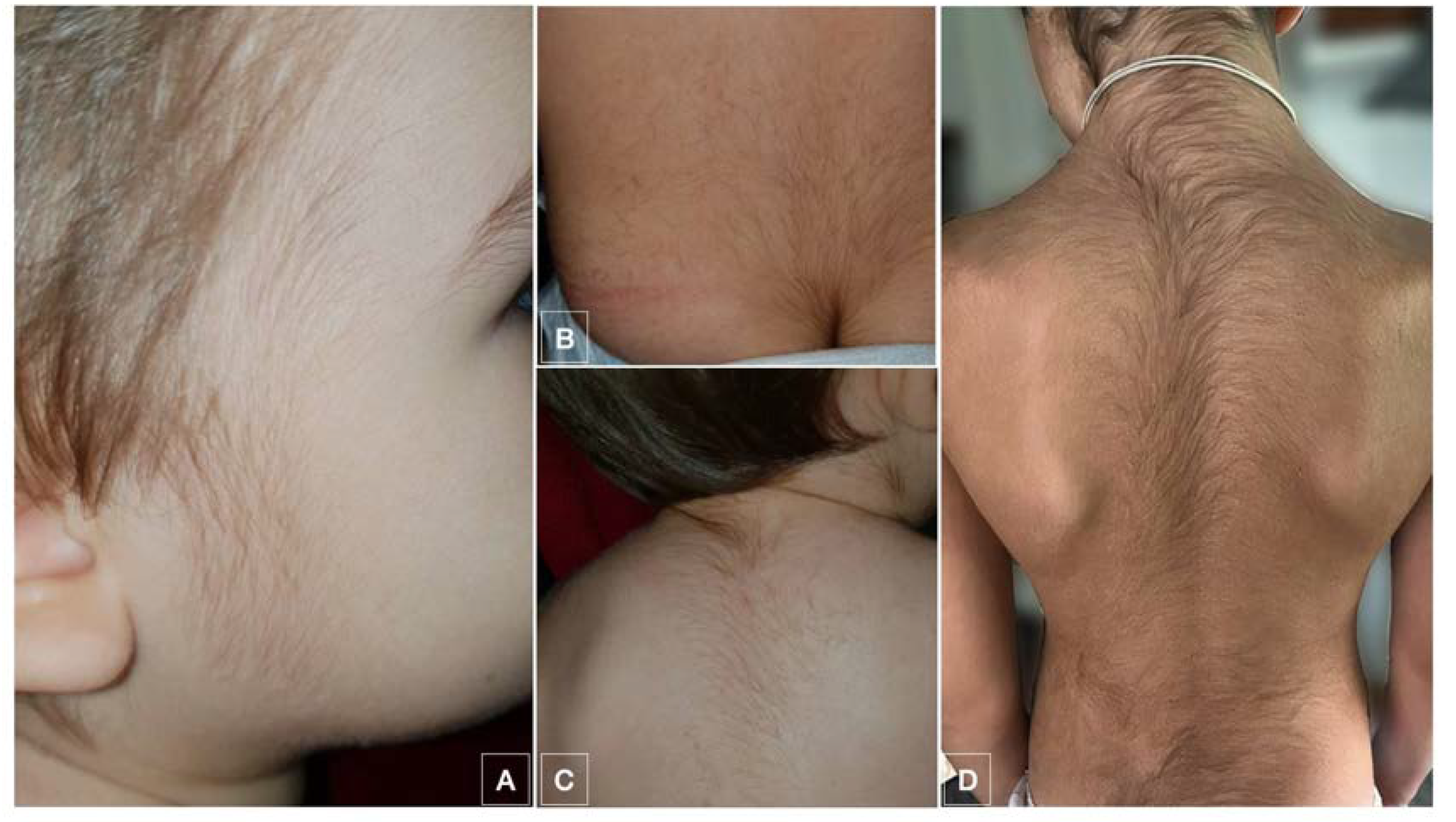 JCM | Free Full-Text | Systemic Minoxidil Accidental Exposure in a Paediatric Population: A Case Series of Cutaneous and Systemic Side Effects