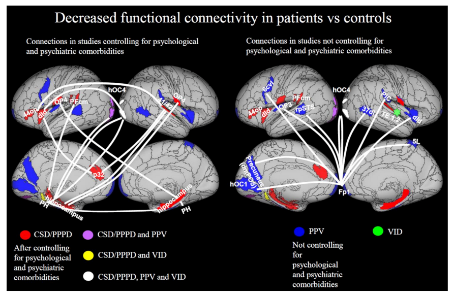 Brain Correlates of Persistent Postural-Perceptual Dizziness