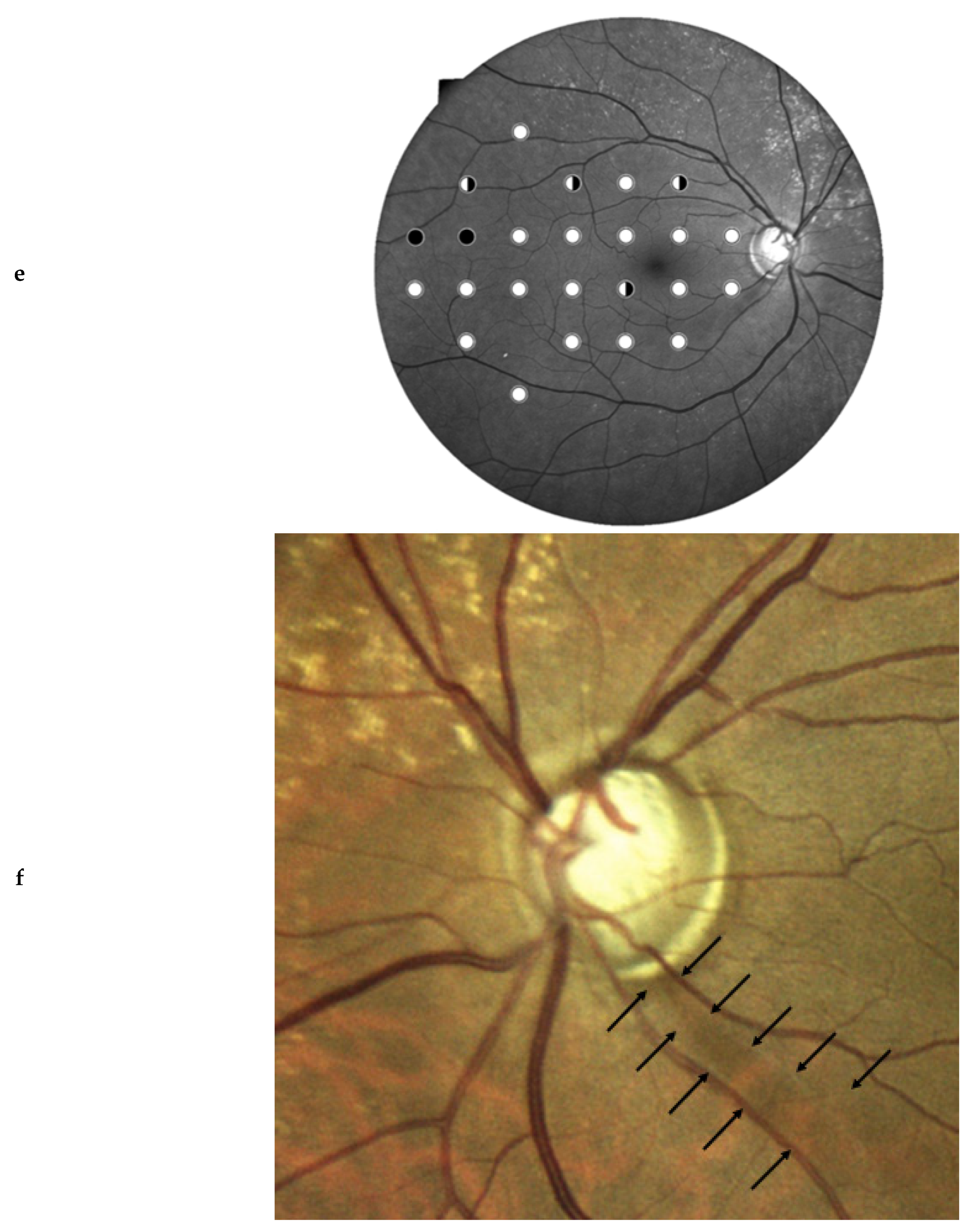 Comparison of Compass Suprathreshold Screening Strategies