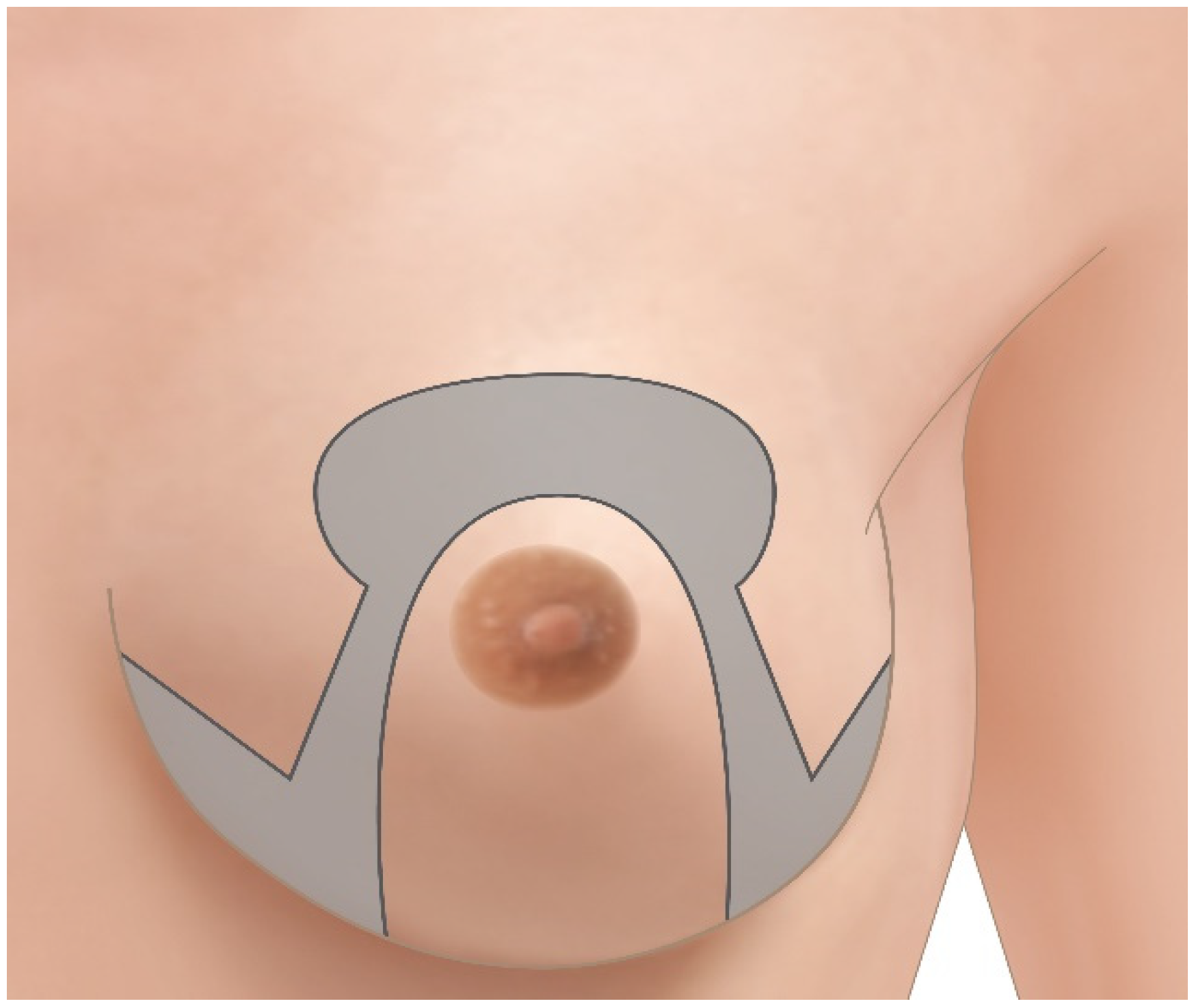 Aesthetic and predictable correction of the inverted nipple