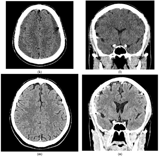Endovascular Treatment of Chronic Subdural Hematomas through