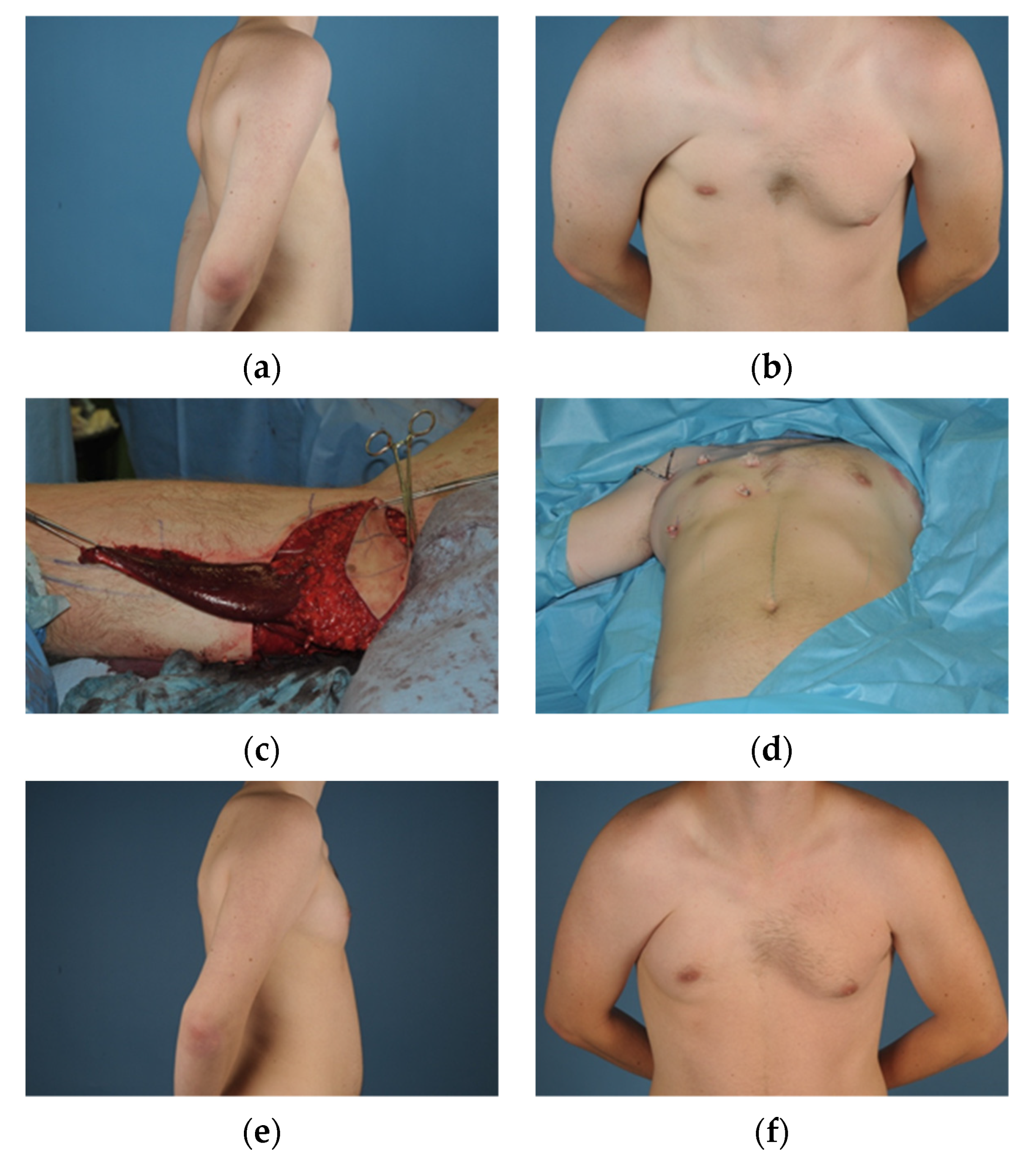 JCM Free Full-Text Development of A Surgical Treatment Algorithm for Breast Reconstruction in Poland Syndrome Patients Considering Severity, Sex, and picture